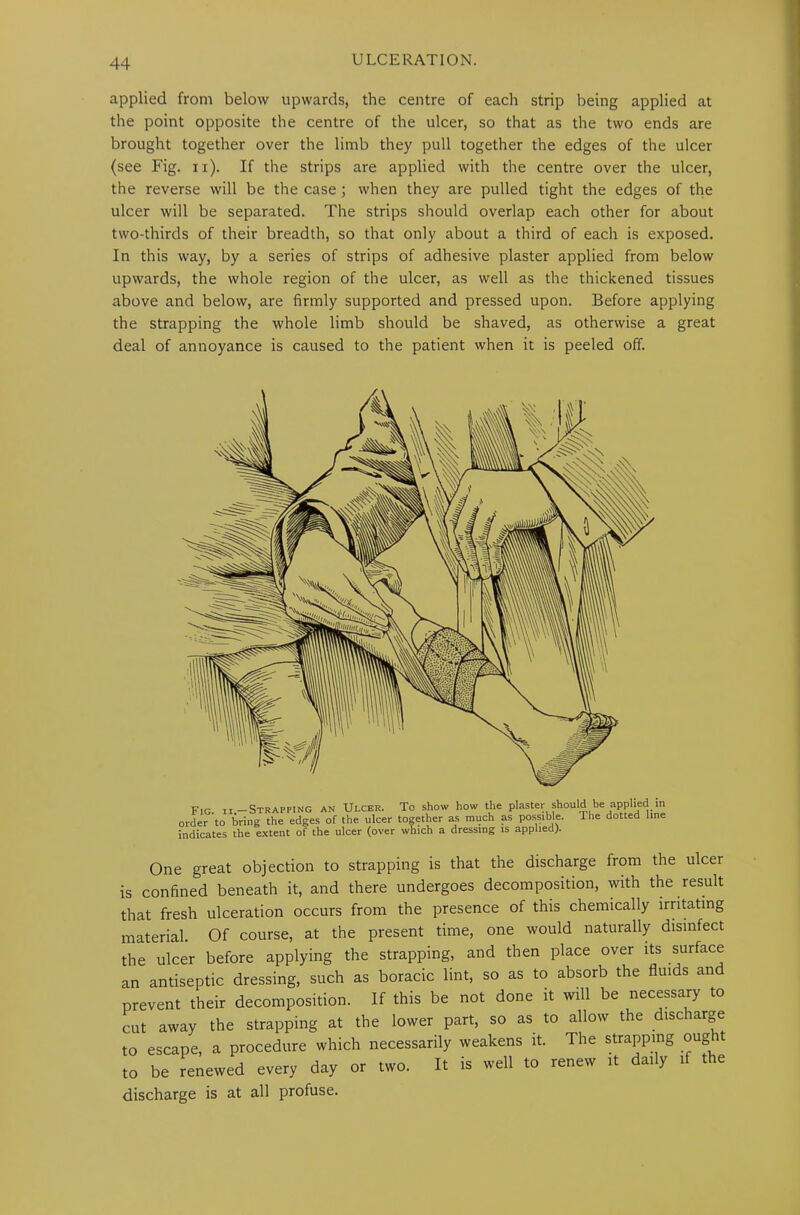 applied from below upwards, the centre of each strip being applied at the point opposite the centre of the ulcer, so that as the two ends are brought together over the limb they pull together the edges of the ulcer (see Fig. n). If the strips are applied with the centre over the ulcer, the reverse will be the case ; when they are pulled tight the edges of the ulcer will be separated. The strips should overlap each other for about two-thirds of their breadth, so that only about a third of each is exposed. In this way, by a series of strips of adhesive plaster applied from below upwards, the whole region of the ulcer, as well as the thickened tissues above and below, are firmly supported and pressed upon. Before applying the strapping the whole limb should be shaved, as otherwise a great deal of annoyance is caused to the patient when it is peeled off. Fig. ii.— Strapping an Ulcer. To show how the plaster should be applied in order to bring the edges of the ulcer together as much as possible. The dotted line indicates the extent of the ulcer (over which a dressing is applied). One great objection to strapping is that the discharge from the ulcer is confined beneath it, and there undergoes decomposition, with the result that fresh ulceration occurs from the presence of this chemically irritating material. Of course, at the present time, one would naturally disinfect the ulcer before applying the strapping, and then place over its surface an antiseptic dressing, such as boracic lint, so as to absorb the fluids and prevent their decomposition. If this be not done it will be necessary to cut away the strapping at the lower part, so as to allow the discharge to escape, a procedure which necessarily weakens it. The strapping oug to be renewed every day or two. It is well to renew it daily if the discharge is at all profuse.