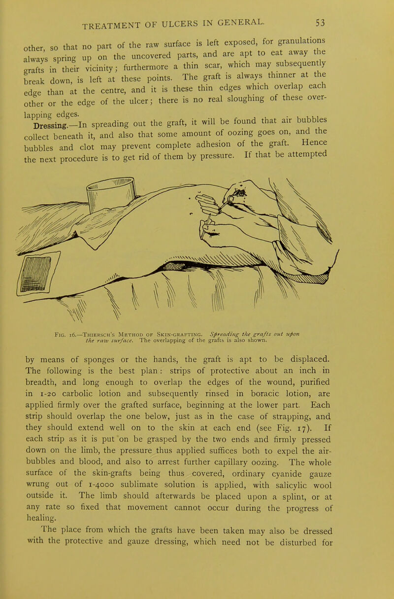 other, so that no pare of the raw surface is left exposed, for granulations always spring up on the uncovered parts, and are apt to eat away the grafts in their vicinity; furthermore a thin scar, which may subsequently break down, is left at these points. The graft is always thinner at the edge than at the centre, and it is these thin edges which overlap each other or the edge of the ulcer; there is no real sloughing of these over- Drmte-In spreading out the graft, it will be found that air bubbles collect beneath it, and also that some amount of oozing goes on, and the bubbles and clot may prevent complete adhesion of the graft. Hence the next procedure is to get rid of them by pressure. If that be attempted Fig. 16.—Thiersch's Method of Skin-grafting. Spreading the grafts out upon the raw surface. The overlapping of the grafts is also shown. by means of sponges or the hands, the graft is apt to be displaced. The following is the best plan : strips of protective about an inch in breadth, and long enough to overlap the edges of the wound, purified in 1-20 carbolic lotion and subsequently rinsed in boracic lotion, are applied firmly over the grafted surface, beginning at the lower part. Each strip should overlap the one below, just as in the case of strapping, and they should extend well on to the skin at each end (see Fig. 17). If each strip as it is put on be grasped by the two ends and firmly pressed down on the limb, the pressure thus applied suffices both to expel the air- bubbles and blood, and also to arrest further capillary oozing. The whole surface of the skin-grafts being thus covered, ordinary cyanide gauze wrung out of 1-4000 sublimate solution is applied, with salicylic wool outside it. The limb should afterwards be placed upon a splint, or at any rate so fixed that movement cannot occur during the progress of healing. The place from which the grafts have been taken may also be dressed with the protective and gauze dressing, which need not be disturbed for