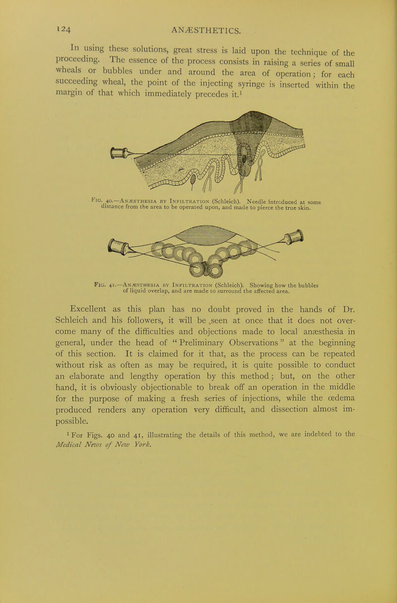 In using these solutions, great stress is laid upon the technique of the proceeding. The essence of the process consists in raising a series of small wheals or bubbles under and around the area of operation; for each succeeding wheal, the point of the injecting syringe is inserted within the margin of that which immediately precedes it.1 Fig. 40.— Anesthesia by Infiltration (Schleicb). Needle introduced at some distance from the area to be operated upon, and made to pierce the true skin. Fig. 41.—Anaesthesia by Infiltration (Schleich). Showing how the bubbles of liquid overlap, and are made to surround the affected area. Excellent as this plan has no doubt proved in the hands of Dr. Schleich and his followers, it will be .seen at once that it does not over- come many of the difficulties and objections made to local anaesthesia in general, under the head of “ Preliminary Observations ” at the beginning of this section. It is claimed for it that, as the process can be repeated without risk as often as may be required, it is quite possible to conduct an elaborate and lengthy operation by this method; but, on the other hand, it is obviously objectionable to break off an operation in the middle for the purpose of making a fresh series of injections, while the oedema produced renders any operation very difficult, and dissection almost im- possible. 1 For Figs. 40 and 41, illustrating the details of this method, we are indebted to the Medical News of New York.