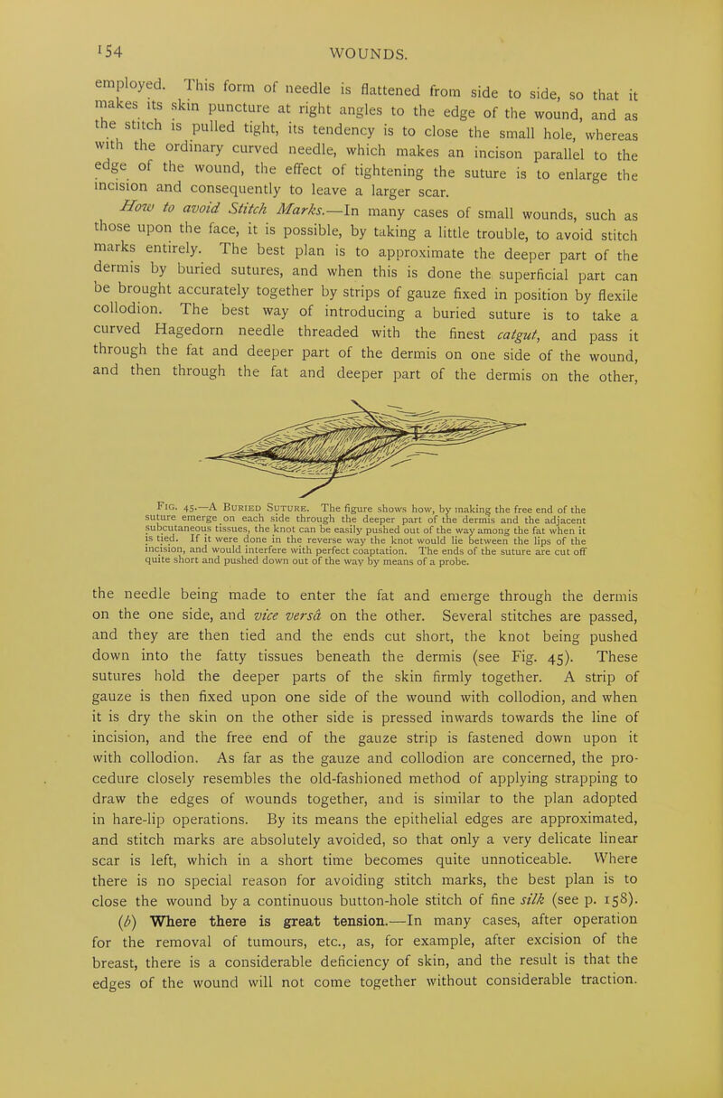 emp oyed. This form of needle is flattened from side to side, so that it makes its skin puncture at right angles to the edge of the wound, and as tie stitch is pulled tight, its tendency is to close the small hole, whereas win the ordinary curved needle, which makes an incison parallel to the edge of the wound, the effect of tightening the suture is to enlarge the incision and consequently to leave a larger scar. H°w to avoid Stitch Marks.—In many cases of small wounds, such as those upon the face, it is possible, by taking a little trouble, to avoid stitch marks entirely. The best plan is to approximate the deeper part of the dermis by buried sutures, and when this is done the superficial part can De brought accurately together by strips of gauze fixed in position by flexile collodion. The best way of introducing a buried suture is to take a curved Hagedorn needle threaded with the finest catgut, and pass it through the fat and deeper part of the dermis on one side of the wound, and then through the fat and deeper part of the dermis on the other, Fig. 45. A Buried Suture. The figure shows how, by making the free end of the suture emerge on each side through the deeper part of the dermis and the adjacent subcutaneous tissues, the knot can be easily pushed out of the way among the fat when it is tied. If it were done in the reverse way the knot would lie between the lips of the incision, and would interfere with perfect coaptation. The ends of the suture are cut off quite short and pushed down out of the way by means of a probe. the needle being made to enter the fat and emerge through the dermis on the one side, and vice versa on the other. Several stitches are passed, and they are then tied and the ends cut short, the knot being pushed down into the fatty tissues beneath the dermis (see Fig. 45). These sutures hold the deeper parts of the skin firmly together. A strip of gauze is then fixed upon one side of the wound with collodion, and when it is dry the skin on the other side is pressed inwards towards the line of incision, and the free end of the gauze strip is fastened down upon it with collodion. As far as the gauze and collodion are concerned, the pro- cedure closely resembles the old-fashioned method of applying strapping to draw the edges of wounds together, and is similar to the plan adopted in hare-lip operations. By its means the epithelial edges are approximated, and stitch marks are absolutely avoided, so that only a very delicate linear scar is left, which in a short time becomes quite unnoticeable. Where there is no special reason for avoiding stitch marks, the best plan is to close the wound by a continuous button-hole stitch of fine silk (see p. 15S). (b) Where there is great tension.—In many cases, after operation for the removal of tumours, etc., as, for example, after excision of the breast, there is a considerable deficiency of skin, and the result is that the edges of the wound will not come together without considerable traction.