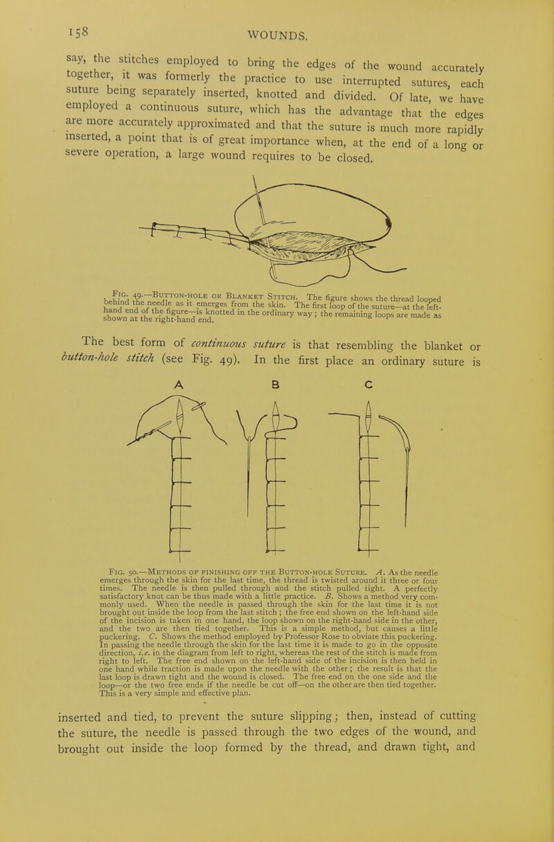 say, the stitches employed to bring the edges of the wound accurately ogether, it was formerly the practice to use interrupted sutures, each suture being separately inserted, knotted and divided. Of late, we have employed a continuous suture, which has the advantage that the edges are more accurately approximated and that the suture is much more rapidly inserted, a point that is of great importance when, at the end of a long or severe operation, a large wound requires to be closed. behind n?edTT°Nv°LE °R Bl'ANKIfr Stitch. The figure shows the thread looped h^nd p„Hh fnled'l aS U ?lerges B?m skin. The first loop of the suture-at the left- shown at the righf-h^d end?0 “ °rdlnary Way 1 the remaininS loops are made as The best form of continuous suture is that resembling the blanket or button-hole stitch (see Fig. 49). In the first place an ordinary suture is Fig. 50.—Methods of finishing off the Button-hole Sutuke. A. As the needle emerges through the skin for the last time, the thread is twisted around it three or four times. The needle is then pulled through and the stitch pulled tight. A perfectly satisfactory knot can be thus made with a little practice. B. Shows a method very com- monly used. When the needle is passed through the skin for the last time it is not brought out inside the loop from the last stitch ; the free end shown on the left-hand side of the incision is taken in one hand, the loop shown on the right-hand side in the other, and the two are then tied together. This is a simple method, but causes a little puckering. C. Shows the method employed by Professor Rose to obviate this puckering. In passing the needle through the skin for the last time it is made to go in the opposite direction, i.e. in the diagram from left to right, whereas the rest of the stitch is made from right to left. The free end shown on the left-hand side of the incision is then held in one hand while traction is made upon the needle with the other; the result is that the last loop is drawn tight and the wound is closed. The free end on the one side and the loop—or the two free ends if the needle be cut off— on the other are then tied together. This is a very simple and effective plan. inserted and tied, to prevent the suture slipping; then, instead of cutting the suture, the needle is passed through the two edges of the wound, and brought out inside the loop formed by the thread, and drawn tight, and