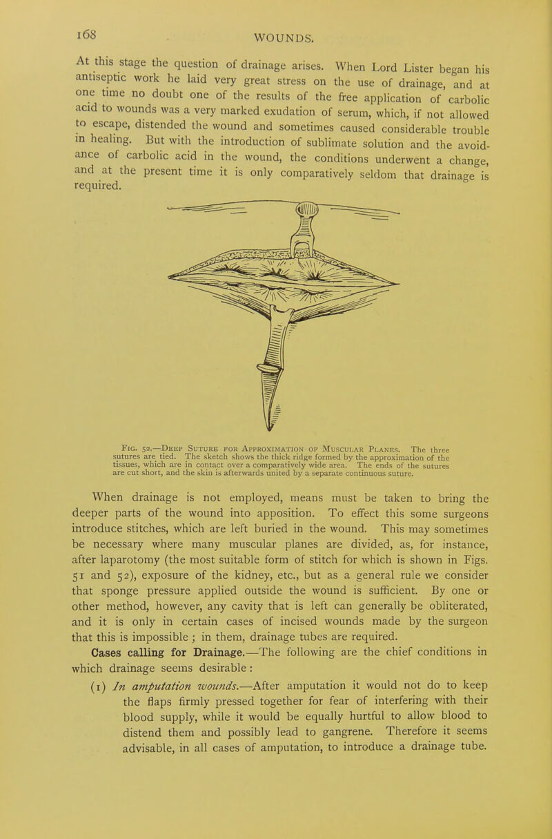 At this stage the question of drainage arises. When Lord Lister began his antiseptic work he laid very great stress on the use of drainage, and at one time no doubt one of the results of the free application of carbolic acid to wounds was a very marked exudation of serum, which, if not allowed to escape, distended the wound and sometimes caused considerable trouble in healing. But with the introduction of sublimate solution and the avoid- ance of carbolic acid in the wound, the conditions underwent a change, and at the present time it is only comparatively seldom that drainage is required. Fig. 52.—Deep Suture for Approximation of Muscular Planes. The three sutures are. tied. The sketch shows the thick ridge formed by the approximation of the tissues, which are in contact over a comparatively wide area. The ends of the sutures are cut short, and the skin is afterwards united by a separate continuous suture. When drainage is not employed, means must be taken to bring the deeper parts of the wound into apposition. To effect this some surgeons introduce stitches, which are left buried in the wound. This may sometimes be necessary where many muscular planes are divided, as, for instance, after laparotomy (the most suitable form of stitch for which is shown in Figs. 51 and 52), exposure of the kidney, etc., but as a general rule we consider that sponge pressure applied outside the wound is sufficient. By one or other method, however, any cavity that is left can generally be obliterated, and it is only in certain cases of incised wounds made by the surgeon that this is impossible ; in them, drainage tubes are required. Cases calling for Drainage.—The following are the chief conditions in which drainage seems desirable : (1) In amputation wounds.—After amputation it would not do to keep the flaps firmly pressed together for fear of interfering with their blood supply, while it would be equally hurtful to allow blood to distend them and possibly lead to gangrene. Therefore it seems advisable, in all cases of amputation, to introduce a drainage tube.