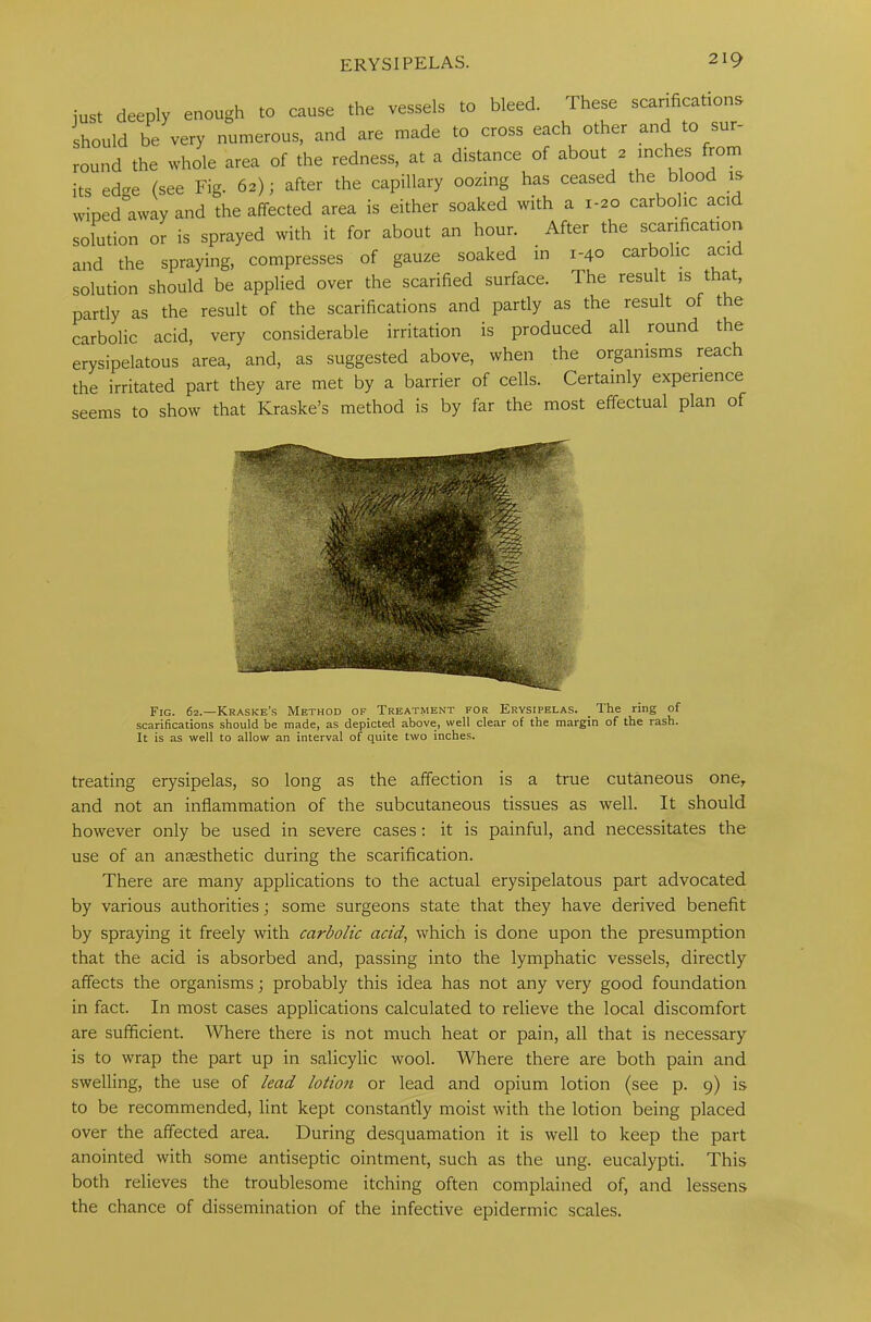 just deeply enough to cause the vessels to bleed. These scarification should be very numerous, and are made to cross each other and to sur- round the whole area of the redness, at a distance of about 2 inches from its ed^e (see Fig. 62); after the capillary oozing has ceased the blood is wiped away and the affected area is either soaked with a 1-20 carbolic acid solution or is sprayed with it for about an hour. After the scarification and the spraying, compresses of gauze soaked in 1-40 carbolic acid solution should be applied over the scarified surface. The result is that, partly as the result of the scarifications and partly as the result of the carbolic acid, very considerable irritation is produced all round the erysipelatous area, and, as suggested above, when the organisms reach the irritated part they are met by a barrier of cells. Certainly experience seems to show that Kraske’s method is by far the most effectual plan of Fig. 62.—Kraske’s Method of Treatment for Erysipelas. _ The ring of scarifications should be made, as depicted above, well clear of the margin of the rash. It is as well to allow an interval of quite two inches. treating erysipelas, so long as the affection is a true cutaneous oney and not an inflammation of the subcutaneous tissues as well. It should however only be used in severe cases: it is painful, and necessitates the use of an anaesthetic during the scarification. There are many applications to the actual erysipelatous part advocated by various authorities; some surgeons state that they have derived benefit by spraying it freely with carbolic acid, which is done upon the presumption that the acid is absorbed and, passing into the lymphatic vessels, directly affects the organisms; probably this idea has not any very good foundation in fact. In most cases applications calculated to relieve the local discomfort are sufficient. Where there is not much heat or pain, all that is necessary is to wrap the part up in salicylic wool. Where there are both pain and swelling, the use of lead lotion or lead and opium lotion (see p. 9) is to be recommended, lint kept constantly moist with the lotion being placed over the affected area. During desquamation it is well to keep the part anointed with some antiseptic ointment, such as the ung. eucalypti. This both relieves the troublesome itching often complained of, and lessens the chance of dissemination of the infective epidermic scales.