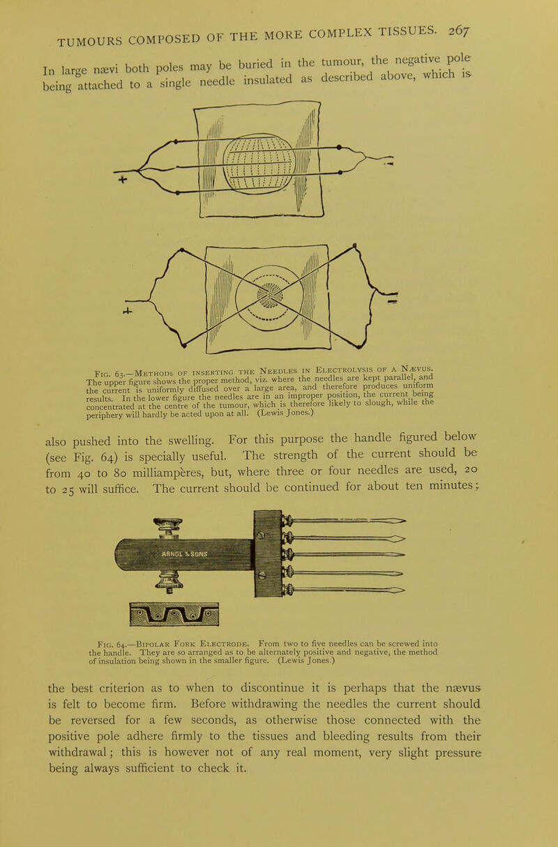 tumours composed of the In large naevi both being attached to a poles may be buried in the tumour, the negative pole single needle insulated as described above, which is FiG. 63.—Methods of inserting the Needles in Electrolysis of a N^vus. The upper figure shows the proper method, viz. where the needles are kept parallel, and the current is uniformly diffused over a large area, and therefore produces uniform results. In the lower figure the needles are in an improper position, the current being concentrated at the centre of the tumour, which is therefore likely to slough, while the periphery will hardly be acted upon at all. (Lewis Jones.) also pushed into the swelling. For this purpose the handle figuied below (see Fig. 64) is specially useful. The strength of the current should be from 40 to 80 milliamperes, but, where three or four needles are used, 20 to 25 will suffice. The current should be continued for about ten minutes; Fig. 64.—Bipolar Fork Electrode. From two to five needles can be screwed into the handle. They are so arranged as to be alternately positive and negative, the method of insulation being shown in the smaller figure. (Lewis Jones ) the best criterion as to when to discontinue it is perhaps that the nsevus is felt to become firm. Before withdrawing the needles the current should be reversed for a few seconds, as otherwise those connected with the positive pole adhere firmly to the tissues and bleeding results from their withdrawal; this is however not of any real moment, very slight pressure being always sufficient to check it.