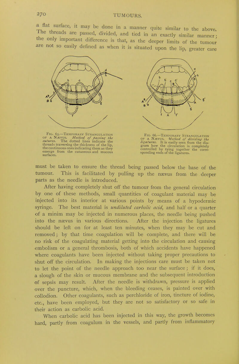,r. L SUrf!CS’ 11 may be done in a manner quite similar to the above, he threads are passed, divided, and tied in an exactly similar manner- the only important difference is that, as the deeper limits of the tumour are not so easily defined as when it is situated upon the lip, greater care Fig. 65.—Temporary Strangulation of A N/f.vus. Method 0/ passing the sutures. The dotted lines indicate the threads traversing the thickness of the lip, the continuous ones indicating them as they emerge from the cutaneous and mucous surfaces. Fig. 66.—Temporary Strangulation of A N/KVUS. Method of dividing the ligatures. It is easily seen from the dia- gram how the circulation is completely controlled by tying together the corre- sponding ends of the ligatures. must be taken to ensure the thread being passed below the base of the tumour. This is facilitated by pulling up the mevus from the deeper parts as the needle is introduced. After having completely shut off the tumour from the general circulation by one of these methods, small quantities of coagulant material may be injected into its interior at various points by means of a hypodermic syringe. The best material is undiluted carbolic acid, and half or a quarter of a minim may be injected in numerous places, the needle being pushed into the nsevus in various directions. After the injection the ligatures should be left on for at least ten minutes, when they may be cut and removed; by that time coagulation will be complete, and there will be no risk of the coagulating material getting into the circulation and causing embolism or a general thrombosis, both of which accidents have happened where coagulants have been injected without taking proper precautions to shut off the circulation. In making the injections care must be taken not to let the point of the needle approach too near the surface ; if it does, a slough of the skin or mucous membrane and the subsequent introduction of sepsis may result. After the needle is withdrawn, pressure is applied over the puncture, which, when the bleeding ceases, is painted over with collodion. Other coagulants, such as perchloride of iron, tincture of iodine, etc., have been employed, but they are not so satisfactory or so safe in their action as carbolic acid. When carbolic acid has been injected in this way, the growth becomes hard, partly from coagulum in the vessels, and partly from inflammatory