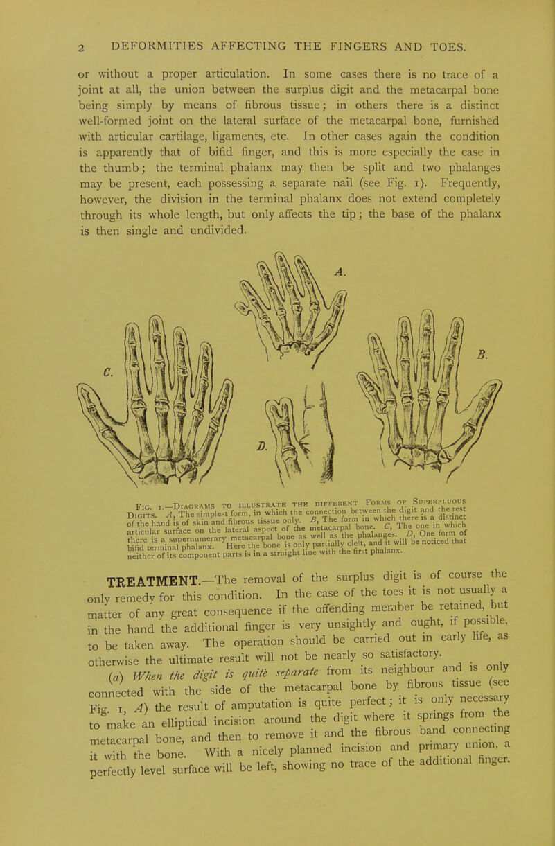 or without a proper articulation. In some cases there is no trace of a joint at all, the union between the surplus digit and the metacarpal bone being simply by means of fibrous tissue; in others there is a distinct well-formed joint on the lateral surface of the metacarpal bone, furnished with articular cartilage, ligaments, etc. In other cases again the condition is apparently that of bifid finger, and this is more especially the case in the thumb; the terminal phalanx may then be split and two phalanges may be present, each possessing a separate nail (see Fig. i). Frequently, however, the division in the terminal phalanx does not extend completely through its whole length, but only affects the tip; the base of the phalanx is then single and undivided. Fir 1 —Diagrams to illustrate the oifferent Forms of Superfluous Digit’s A The simplest form, in which the connection between the digit and ?f\he hand is of ski7and fibrou’s tissue only The '^‘^-‘’.^^ronrin^Xh articular surface on the lateral XX^he phaTan^e^ D, oL fo^^^ neither of its component parts is in a straight line with the first phalanx. TREATMENT.—The removal of the surplus digit is of course the only remedy for this condition. In the case of the toes it is not usually a matter of any great consequence if the offending member be retained, but in the hand the additional finger is very unsightly and ought, if possib e, to be taken away. The operation should be carried out in early life, as otherwise the ultimate result will not be nearly so satisfactory. _ (a) When the digit is quite separate from its i^eighbour and is only connected with the side of the metacarpal bone by fibrous tissue (see Fig I A) the result of amputation is quite perfect; it is only necessary to maL an elliptical incision around the digit where it springs from the meLarpaTbon and then to remove it and the fibrous band connecting perfectly levei°surface will be left, showing no trace of the additional finger.