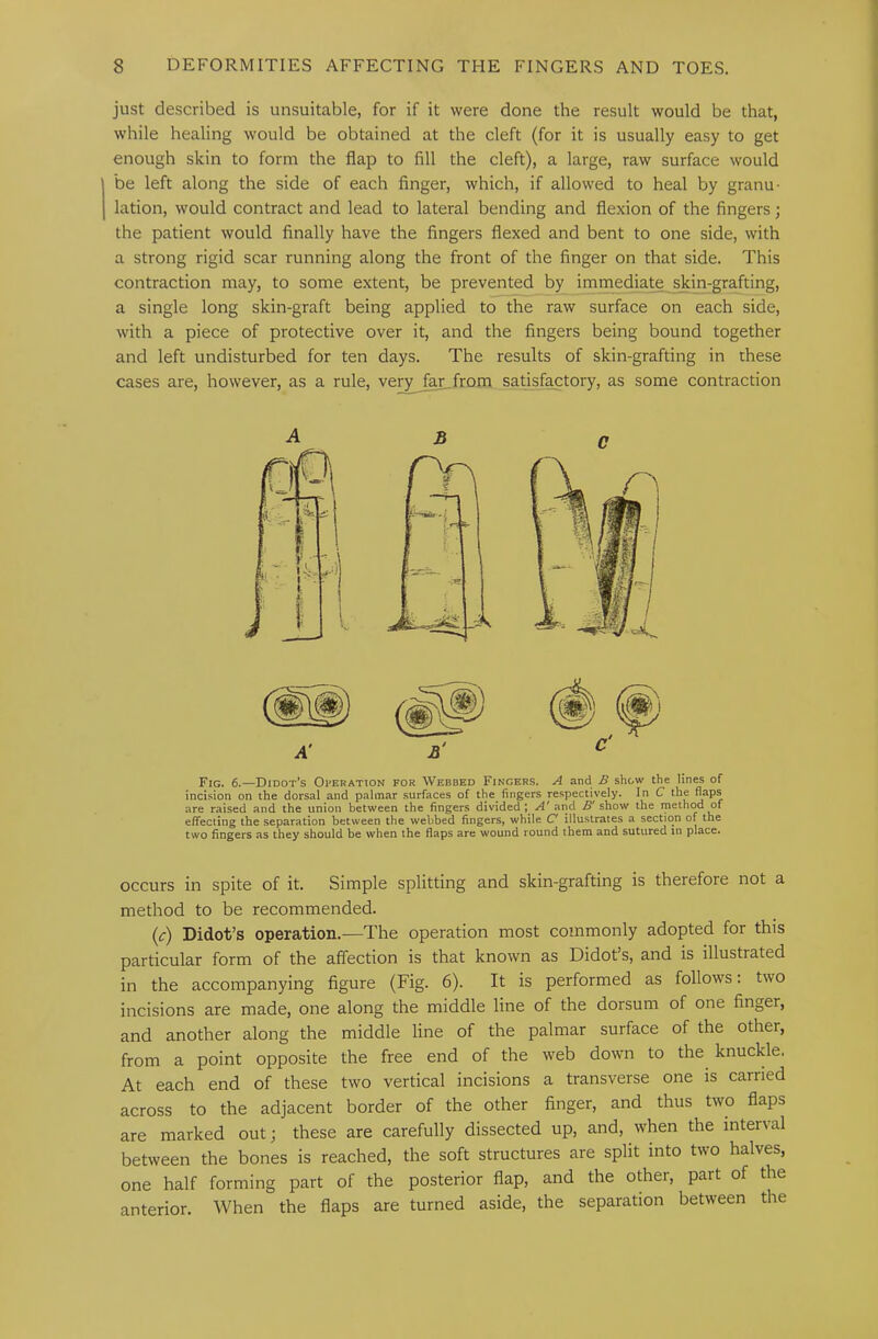 just described is unsuitable, for if it were done the result would be that, while healing would be obtained at the cleft (for it is usually easy to get enough skin to form the flap to fill the cleft), a large, raw surface would be left along the side of each finger, which, if allowed to heal by granu- lation, would contract and lead to lateral bending and flexion of the fingers; the patient would finally have the fingers flexed and bent to one side, with a strong rigid scar running along the front of the finger on that side. This contraction may, to some extent, be prevented by immediate skin-grafting, a single long skin-graft being applied to the raw surface on each side, with a piece of protective over it, and the fingers being bound together and left undisturbed for ten days. The results of skin-grafting in these cases are, however, as a rule, very J^from satisfactory, as some contraction Fig. 6.—Didot’s Operation for Webbed Fingers. A and B show the of incision on the dorsal and palmar surfaces of the fingers respectively. In C the are raised and the union between the fingers divided J and .5'show the method of effecting the separation between the webbed fingers, while C' illustrates a section of the two fingers as they should be when the fiaps are wound round them and sutured in place. occurs in spite of it. Simple splitting and skin-grafting is therefore not a method to be recommended. (c) Didot’s operation.—The operation most commonly adopted for this particular form of the affection is that known as Didot’s, and is illustrated in the accompanying figure (Fig. 6). It is performed as follows: two incisions are made, one along the middle line of the dorsum of one finger, and another along the middle line of the palmar surface of the other, from a point opposite the free end of the web down to the knuckle. At each end of these two vertical incisions a transverse one is carried across to the adjacent border of the other finger, and thus two flaps are marked out; these are carefully dissected up, and, when the interval between the bones is reached, the soft structures are split into two halves, one half forming part of the posterior flap, and the oAer, part of the anterior. When the flaps are turned aside, the separation between the