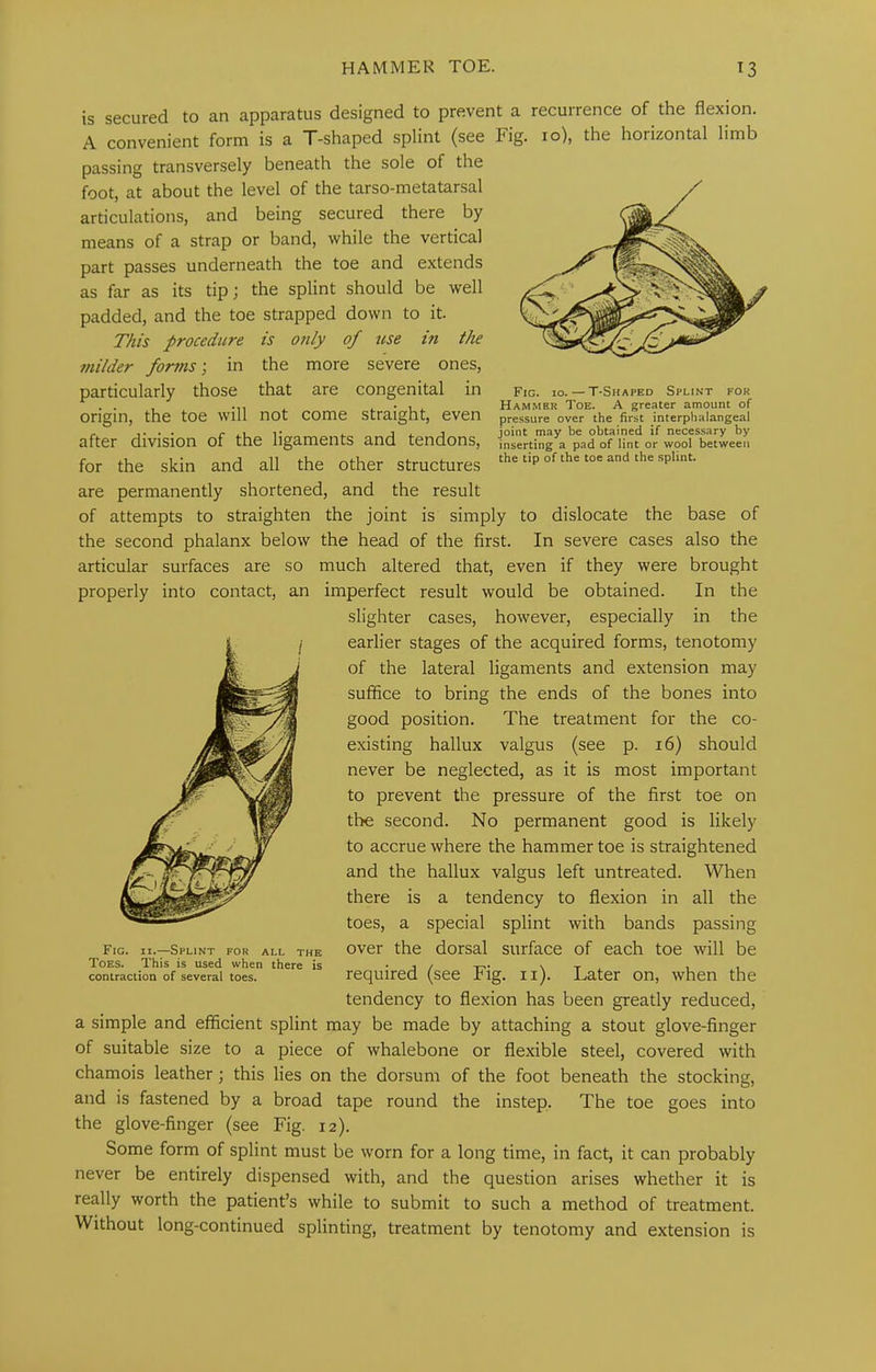 is secured to an apparatus designed to prevent a recurrence of the flexion. A convenient form is a T-shaped splint (see Fig. lo), the horizontal limb passing transversely beneath the sole of the foot, at about the level of the tarso-metatarsal articulations, and being secured there by means of a strap or band, while the vertical part passes underneath the toe and extends as far as its tip; the splint should be well padded, and the toe strapped down to it. T/iis procedure is only of use in the 7nilder forms; in the more severe ones, particularly those that are congenital in fig. lo.—T-Shaped Splint for ... -11 • L/. Hammer Toe. A greater amount of origin, the toe will not come straight, even pressure over the first interphalangeal after division of the ligaments and tendons, inserting a pad of lint or wool between for the skin and all the other structures the tip of the toe and the spUnt. are permanently shortened, and the result of attempts to straighten the joint is simply to dislocate the base of the second phalanx below the head of the first. In severe cases also the articular surfaces are so much altered that, even if they were brought properly into contact, an imperfect result would be obtained. In the slighter cases, however, especially in the earlier stages of the acquired forms, tenotomy of the lateral ligaments and extension may suffice to bring the ends of the bones into good position. The treatment for the co- existing hallux valgus (see p. i6) should never be neglected, as it is most important to prevent the pressure of the first toe on the second. No permanent good is likely to accrue where the hammer toe is straightened and the hallux valgus left untreated. When there is a tendency to flexion in all the toes, a special splint with bands passing over the dorsal surface of each toe will be required (see Fig. ii). Later on, when the tendency to flexion has been greatly reduced, a simple and efficient splint may be made by attaching a stout glove-finger of suitable size to a piece of whalebone or flexible steel, covered with chamois leather; this lies on the dorsum of the foot beneath the stocking, and is fastened by a broad tape round the instep. The toe goes into the glove-finger (see Fig. 12). Some form of splint must be worn for a long time, in fact, it can probably never be entirely dispensed with, and the question arises whether it is really worth the patient’s while to submit to such a method of treatment. Without long-continued splinting, treatment by tenotomy and extension is Fig. II.—Splint for all the Toes. This is used when there is contraction of several toes.
