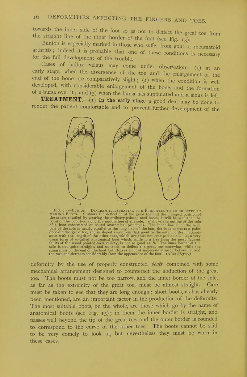 towards the inner side of the foot so as not to deflect the great toe from the straight line of the inner border of the foot (see Fig. 13). Bunion is especially marked in those who suffer from gout or rheumatoid arthritis; indeed it is probable that one of these conditions is necessary tor the full development of the trouble. Cases of hallu.x valgus may come under observation; (i) at an early stage, when the divergence of the toe and the enlargement of the end of the bone are comparatively slight; (2) when the condition is well developed, with considerable enlargement of the bone, and the formation of a bursa over it; and (3) when the bursa has suppurated and a sinus is left. TREATMENT.—(i) In the early stage a good deal may be done to render the patient comfortable and to prevent further development of the Fig. 13.—Bunion. Diagram illustrating the Principles to be observed in MAKING Boots. C shows the deflection of the great toe and the cramped position of the others entailed^ by wearing the ordinary pointed-toed boots; it will be seen that the point of the boot lies along the middle line of the sole. B .shows the outline of the sole of a boot constructed on sound anatomical principles. The inner border of the front part of the sole is nearly parallel to the long axis of the foot, the boot comes to a point opposite the great toe, and is sloped away from that point to the outer border in accord- ance with the length of the other toes, which are thus not cramped at all. a very usual form of so-called anatomical boot which, while it is free from the most flagmnt faults of the usual pointed-toed variety, is not so good as B. The inner border of the sole is not quite straight, and so tends to deflect the great toe somewhat, while the squareness of the end of the boot both leaves a lot of unnecessary space between it and the toes and detracts considerably from the appearance of the foot. (After Meyer*') deformity by the use of properly constructed boots combined with some mechanical arrangement designed to counteract the abduction of the great toe. The boots must not be too narrow, and the inner border of the sole, as far as the extremity of the great toe, must be almost straight. Care must be taken to see that they are long enough; short boots, as has already been mentioned, are an important factor in the production of the deformity. The most suitable boots, on the whole, are those which go by the name of anatomical boots (see Fig. 13); in them the inner border is straight, and passes well beyond the tip of the great toe, and the outer border is rounded to correspond to the curve of the other toes. The boots cannot be said to be very comely to look at, but nevertheless they must be worn in these cases.