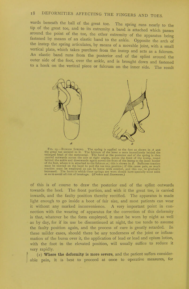 wards beneath the ball of the great toe. The spring runs nearly to the tip of the great toe, and to its extremity a band is attached which passes around the point of the toe, the other extremity of the apparatus being fastened by means of an elastic band to the ankle. Opposite the arch of the instep the spring articulates, by means of a movable joint, with a small vertical plate, which takes purchase from the instep and acts as a fulcrum. An elastic band runs from the posterior end of the splint around the outer side of the foot, over the ankle, and is brought down and fastened to a hook on the vertical piece or fulcrum on the inner side. The result Fig. 15.—Bunion Spring. The .spring is applied to the foot as shown in A and the great toe secured to it. The fulcrum of the lever n rests immediately behind the enlarged head of the metatarsal. The band at the posterior end of the spring is then carried outwards across the sole at right angles, across the front of the instep, round behind the ankle and downwards again across the front of the instep to the inner border of the foot, where it is attached to the fulcrum a; this is shown in B. Sufficient traction must be exerted on the band to pull the toe into position J if this cause pain, as much traction must be employed as can be borne with comfort, and this can be gradually increased. The boots in which these springs are worn should have specially stout soles so as to avoid all risk of breakage. {Kroknc and Sesemamu) of this is of course to draw the posterior end of the splint outwards towards the heel. The front portion, and with it the great toe, is carried inwards, and the faulty position thereby rectified. The apparatus is made light enough to go inside a boot of fair size, and most patients can wear it without any marked inconvenience. A very important point in con- nection with the wearing of apparatus for the correction of this deformity is that, whatever be the form employed, it must be worn by night as well as by day, for if its use be discontinued at night, the toe tends to assume the faulty position again, and the process of cure is greatly retarded. In these milder cases, should there be any tenderness of the joint or inflam- mation of the bursa over it, the application of lead or lead and opium lotion, with the foot in the elevated position, will usually suffice to reduce it very rapidly. (2) Where the deformity is more severe, and the patient suffers consider- able pain, it is best to proceed at once to operative measures, for