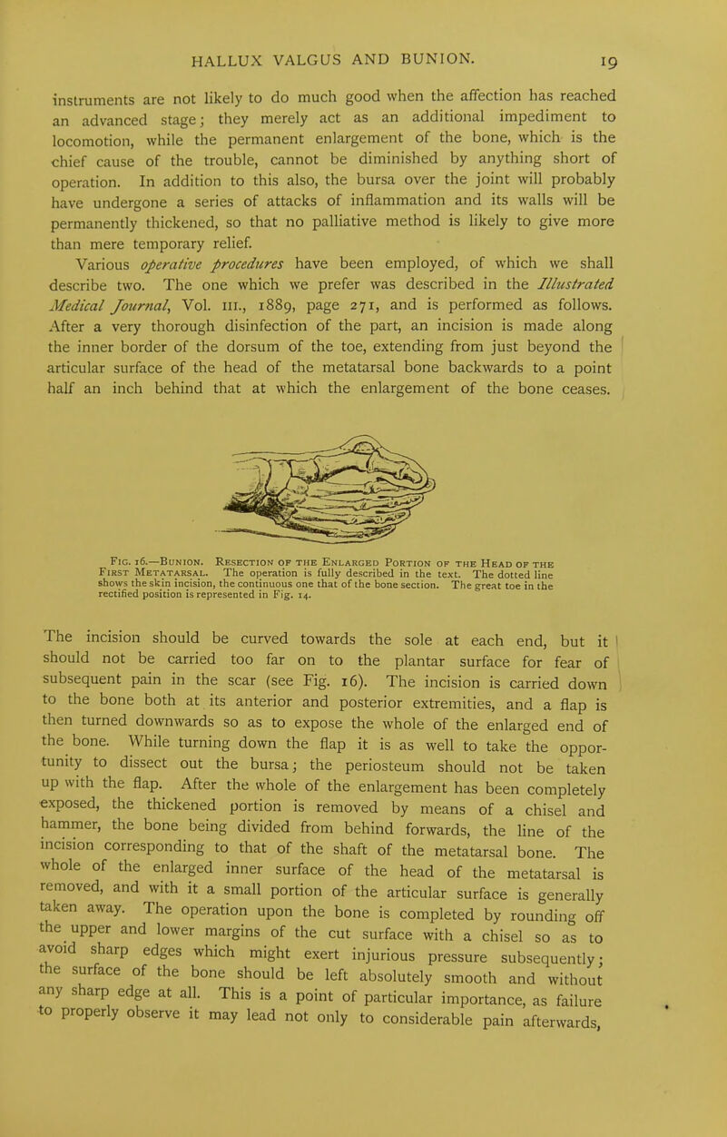 instruments are not likely to do much good when the affection has reached an advanced stage; they merely act as an additional impediment to locomotion, while the permanent enlargement of the bone, which is the chief cause of the trouble, cannot be diminished by anything short of operation. In addition to this also, the bursa over the joint will probably have undergone a series of attacks of inflammation and its walls will be permanently thickened, so that no palliative method is likely to give more than mere temporary relief. Various operative procedures have been employed, of which we shall describe two. The one which we prefer was described in the Illustrated Medical Journal, Vol. iii., 1889, page 271, and is performed as follows. After a very thorough disinfection of the part, an incision is made along the inner border of the dorsum of the toe, extending from just beyond the articular surface of the head of the metatarsal bone backwards to a point half an inch behind that at which the enlargement of the bone ceases. Fig. 16.—Bunion. Resection of the Enlarged Portion of the Head of the First Metatarsal. The operation is fully described in the text. The dotted line shows the skin incision, the continuous one that of the bone section. The great toe in the rectified position is represented in Fig. 14. The incision should be curved towards the sole at each end, but it I should not be carried too far on to the plantar surface for fear of subsequent pain in the scar (see Fig. i6). The incision is carried down to the bone both at its anterior and posterior extremities, and a flap is then turned downwards so as to expose the whole of the enlarged end of the bone. While turning down the flap it is as well to take the oppor- tunity to dissect out the bursa; the periosteum should not be taken up with the flap. After the whole of the enlargement has been completely exposed, the thickened portion is removed by means of a chisel and hammer, the bone being divided from behind forwards, the line of the incision corresponding to that of the shaft of the metatarsal bone. The whole of the enlarged inner surface of the head of the metatarsal is removed, and with it a small portion of the articular surface is generally taken away. The operation upon the bone is completed by rounding off the upper and lower margins of the cut surface with a chisel so as to avoid sharp edges which might exert injurious pressure subsequently; the surface of the bone should be left absolutely smooth and without any sharp edge at all. This is a point of particular importance, as failure to properly observe it may lead not only to considerable pain afterwards,