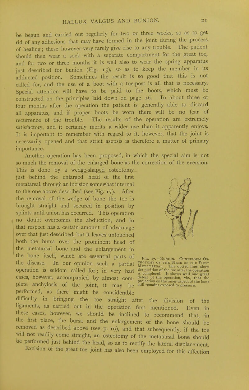be begun and carried out regularly for two or three weeks, so as to get rid of any adhesions that may have formed in the joint during the process of healing; these however very rarely give rise to any trouble. The patient should then wear a sock with a separate compartment for the great toe, and for two or three months it is well also to wear the spring apparatus just described for bunion (Fig. 15)) so as to keep the member in its adducted position. Sometimes the result is so good that this is not called for, and the use of a boot with a toe-post is all that is necessary. Special attention will have to be paid to the boots, which must be constructed on the principles laid down on page 16. In about three or four months after the operation the patient is generally able to discard all apparatus, and if proper boots be worn there will be no fear of recurrence of the trouble. The results of the operation are extremely satisfactory, and it certainly merits a wider use than it apparently enjoys. It is important to remember with regard to it, however, that the joint is necessarily opened and that strict asepsis is therefore a matter of primary importance. Another operation has been proposed, in which the special aim is not so much the removal of the enlarged bone as the correction of the eversion. This is done by a wedge-shaped, osteotomy just behind the enlarged head of the first metatarsal, through an incision somewhat internal to the one above described (see Fig. 17). After the removal of the wedge of bone the toe is brought straight and secured in position by splints until union has occurred. This operation no doubt overcomes the abduction, and in that respect has a certain amount of advantage over that just described, but it leaves untouched both the bursa over the prominent head of : the metatarsal bone and the enlargement in ' the bone itself, which are essential parts of .,._bo.,o». Cos.,,™., o,- the disease. In our opinion such a partial operation is seldom called for: in very bad position of the toe after the operation , ^ ^ IS completed. It shows well one great cases, however, accompanied by almost com- operation, viz., that the , 1 1 • r 1 . . . projection on the inner aspect of the bone plete anchylosis of the joint, it may be remains exposed to pressure. performed, as there might be considerable difficulty in bringing the toe straight after the division of the ligaments, as carried out in the operation first mentioned. Even in these cases, however, we should be inclined to recommend that, -in the first place, the bursa and the enlargement of the bone should be removed as described above (see p. 19), and that subsequently, if the toe will not readily come straight, an osteotomy of the metatarsal bone should be performed just behind the head, so as to rectify the lateral displacement. Excision of the great toe joint has also been employed for this affection