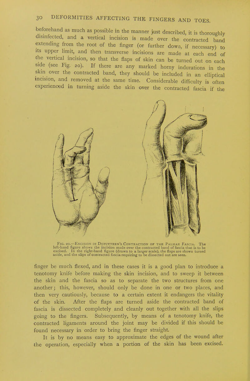 beforehand as much as possible in the manner just described, it is thoroughly disinfected, and a vertical incision is made over the contracted band extending from the root of the finger (or further down, if necessary) to Its upper limit, and then transverse incisions are made at each end of the vertical incision, so that the flaps of skin can be turned out on each side (see Fig. 20). If there are any marked horny indurations in the skin over the contracted band, they should be included in an elliptical incision, and removed at the same time. Considerable difficulty is often experienced in turning aside the skin over the contracted fascia if the Fig. 20.—E.ncision in Dupuytren’s Contraction of the Palmar Fascia. The lefl-hand figure shows the incision made over the contracted band of fascia that is to be excised. In the right-hand figure (drawn to a larger scale), the flaps are shown turned aside, and the slips of contracted fascia requiring to be dissected out are seen. finger be much flexed, and in these cases it is a good plan to introduce a tenotomy knife before making the skin incision, and to sweep it between the skin and the fascia so as to separate the two structures from one another; this, however, should only be done in one or two places, and then very cautiously, because to a certain extent it endangers the vitality of the skin. After the flaps are turned aside the contracted band of fascia is dissected completely and cleanly out together with all the slips going to the fingers. Subsequently, by means of a tenotomy knife, the contracted ligaments around the joint may be divided if this should be found necessary in order to bring the finger straight. It is by no means easy to approximate the edges of the wound after the operation, especially when a portion of the skin has been excised.