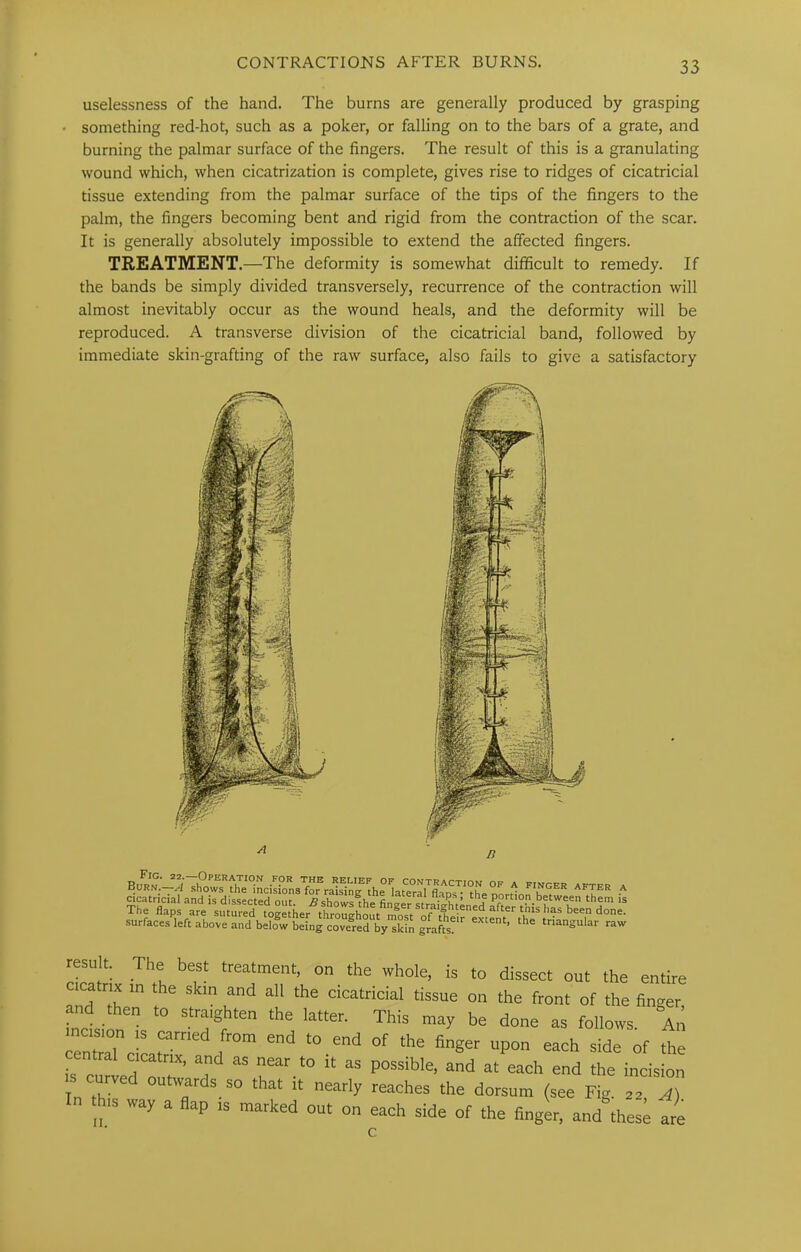 CONTRACTIONS AFTER BURNS. uselessness of the hand. The burns are generally produced by grasping something red-hot, such as a poker, or falling on to the bars of a grate, and burning the palmar surface of the fingers. The result of this is a granulating wound which, when cicatrization is complete, gives rise to ridges of cicatricial tissue extending from the palmar surface of the tips of the fingers to the palm, the fingers becoming bent and rigid from the contraction of the scar. It is generally absolutely impossible to extend the affected fingers. TREATMENT.—The deformity is somewhat difficult to remedy. If the bands be simply divided transversely, recurrence of the contraction will almost inevitably occur as the wound heals, and the deformity will be reproduced. A transverse division of the cicatricial band, followed by immediate skin-grafting of the raw surface, also fails to give a satisfactory the' cicatricial and is dissected out. B shows the finaer siraithil. P°«ion between them is The flaps are sutured together throughout ^one. surfaces left above and below being covered by skin grafts? ’ ^ ‘n=tngular raw resu t. The best treatment, on the whole, is to dissect out the entire cuatnx m the skin and all the cicatricial tissue on the front of the finger and then to straighten the latter. This may be done as follows An “ culd 2 r’' ‘“ “ “ “-vision IS OTved outwards so that it nearly reaches the dorsum (see Fig. as A) his way a flap is marked out on each side of the finger, and these are