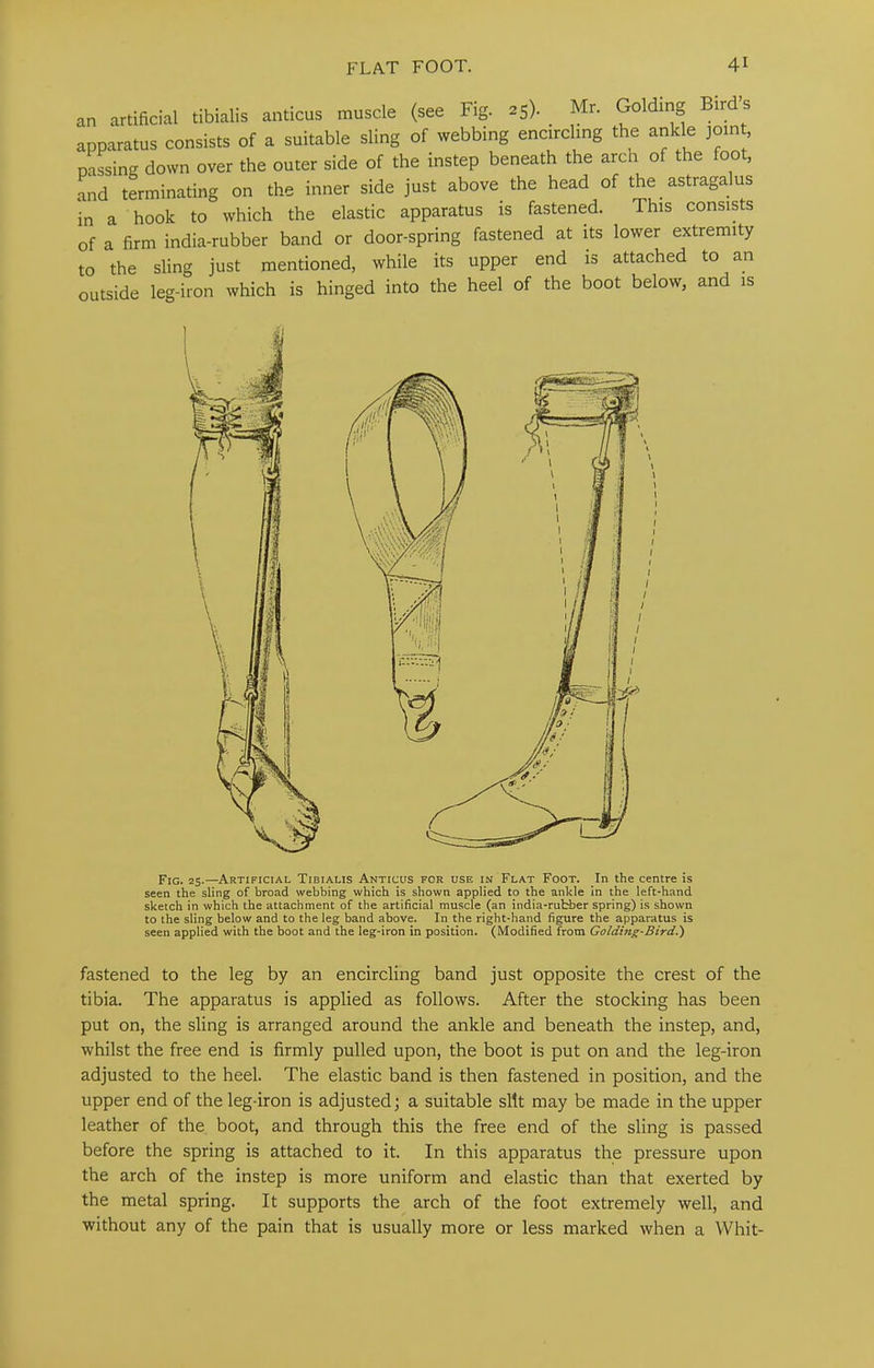 an artificial tibialis anticus muscle (see Fig. 25). _ Mr. Goldmg Birds apparatus consists of a suitable sling of webbing encircling the ankle joint pacing down over the outer side of the instep beneath the arch of the foot, and terminating on the inner side just above the head of the astragalus in a hook to which the elastic apparatus is fastened. This consists of a firm india-rubber band or door-spring fastened at its lower extremity to the sling just mentioned, while its upper end is attached to an outside leg-iron which is hinged into the heel of the boot below, and is Fig. 25.—Artificial Tibialis Anticus for use in Flat Foot. In the centre is seen the sling of broad webbing which is shown applied to the ankle in the left-hand sketch in which the attachment of the artificial muscle (an india-rubber spring) is shown to the sling below and to the leg band above. In the right-hand figure the apparatus is seen applied with the boot and the leg-iron in position. (Modified from Golding-Bird.) fastened to the leg by an encircling band just opposite the crest of the tibia. The apparatus is applied as follows. After the stocking has been put on, the sling is arranged around the ankle and beneath the instep, and, whilst the free end is firmly pulled upon, the boot is put on and the leg-iron adjusted to the heel. The elastic band is then fastened in position, and the upper end of the leg-iron is adjusted; a suitable silt may be made in the upper leather of the boot, and through this the free end of the sling is passed before the spring is attached to it. In this apparatus the pressure upon the arch of the instep is more uniform and elastic than that exerted by the metal spring. It supports the arch of the foot extremely well, and without any of the pain that is usually more or less marked when a Whit-