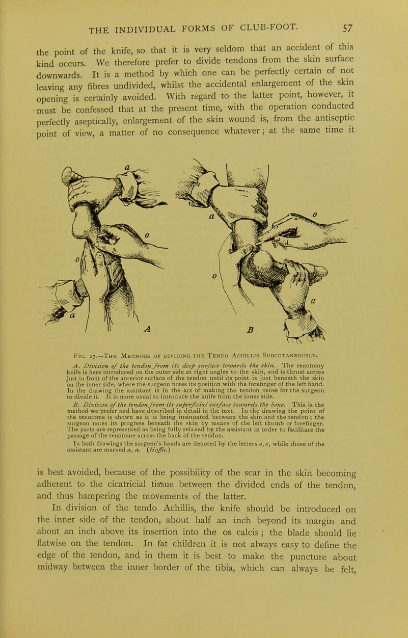 the point of the knife, so that it is very seldom that an accident of this kind occurs. We therefore prefer to divide tendons from the skin surface downwards. It is a method by which one can be perfectly certain of not leaving any fibres undivided, whilst the accidental enlargement of the skin opening is certainly avoided. With regard to the latter point, however, it must be confessed that at the present time, with the operation conducted perfectly aseptically, enlargement of the skin wound is, from the antiseptic point of view, a matter of no consequence whatever; at the same time it Fig. 27.—The Methods of dividing the Tendo Achillis Subcutaneously. A. DivisioK of the tendon from its deep surface towards the skin. The tenotomy knife is here introduced on the outer side at right angles to the skin, and is thrust across just in front of the anterior surface of the tendon until its point is just beneath the skin on the inner side, where the surgeon notes its position with the forefinger of the left hand. In the drawing the assistant is in the act of making the tendon tense for the surgeon to divide it. It is more usual to introduce the knife from the inner side. B. Division of the tendon from its superficial s^trface towards the bone. This is the method we prefer and have described in detail in the text. In the drawing the point of the tenotome is shown as it is being insinuated between the skin and the tendon ; the surgeon notes its progress beneath the skin by means of the left thumb or forefinger. The parts are represented as being fully relaxed by the assistant in order to facilitate the passage of the tenotome across the back of the tendon. In both drawings the surgeon’s hands are denoted by the letters o,o^ while those of the assistant are marked a, a. (Hofi^a.) is best avoided, because of the possibility of the scar in the skin becoming adherent to the cicatricial tissue between the divided ends of the tendon, and thus hampering the movements of the latter. In division of the tendo Achillis, the knife should be introduced on the inner side of the tendon, about half an inch beyond its margin and about an inch above its insertion into the os calcis; the blade should lie flatwise on the tendon. In fat children it is not always easy to define the edge of the tendon, and in them it is best to make the puncture about midway between the inner border of the tibia, which can always be felt.