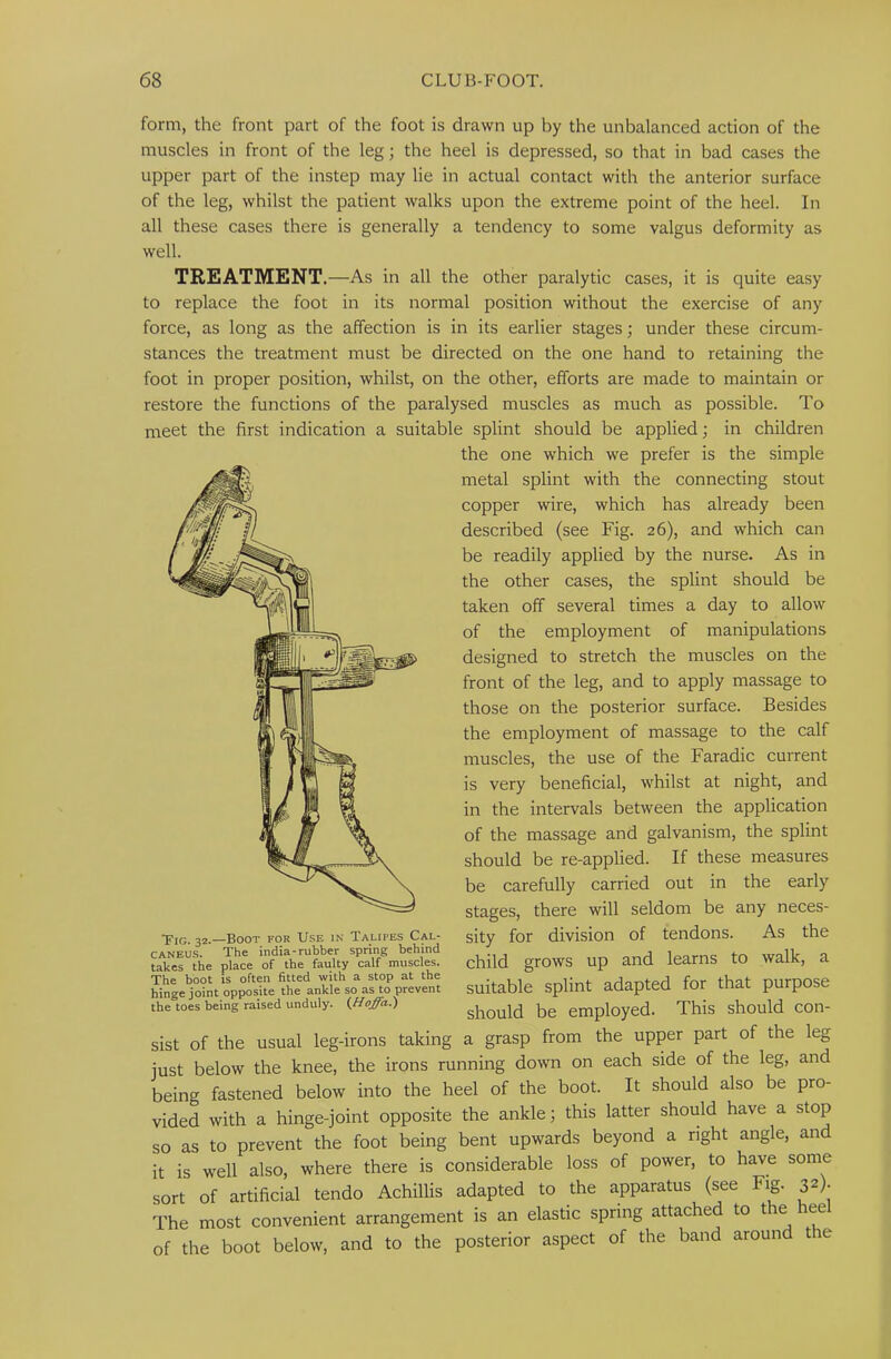 form, the front part of the foot is drawn up by the unbalanced action of the muscles in front of the leg; the heel is depressed, so that in bad cases the upper part of the instep may lie in actual contact with the anterior surface of the leg, whilst the patient walks upon the extreme point of the heel. In all these cases there is generally a tendency to some valgus deformity as well. TREATMENT. —As in all the other paralytic cases, it is quite easy to replace the foot in its normal position without the exercise of any force, as long as the affection is in its earlier stages; under these circum- stances the treatment must be directed on the one hand to retaining the foot in proper position, whilst, on the other, efforts are made to maintain or restore the functions of the paralysed muscles as much as possible. To meet the first indication a suitable splint should be applied; in children the one which we prefer is the simple metal splint with the connecting stout copper wire, which has already been described (see Fig. 26), and which can be readily applied by the nurse. As in the other cases, the splint should be taken off several times a day to allow of the employment of manipulations designed to stretch the muscles on the front of the leg, and to apply massage to those on the posterior surface. Besides the employment of massage to the calf muscles, the use of the Faradic current is very beneficial, whilst at night, and in the intervals between the application of the massage and galvanism, the splint should be re-applied. If these measures be carefully carried out in the early stages, there will seldom be any neces- sity for division of tendons. As the child grows up and learns to walk, a suitable splint adapted for that purpose should be employed. This should con- sist of the usual leg-irons taking a grasp from the upper part of the leg just below the knee, the irons running down on each side of the leg, and being fastened below into the heel of the boot. It should also be pro- vided with a hinge-joint opposite the ankle; this latter should have a stop so as to prevent the foot being bent upwards beyond a right angle, and it is well also, where there is considerable loss of power, to have some sort of artificial tendo Achillis adapted to the apparatus (see Fig. 32). The most convenient arrangement is an elastic spring attached to t e ee of the boot below, and to the posterior aspect of the band around the Tig. 32.—Boot for Use in Talipes Cal- caneus. The india-rubber spring behind takes the place of the faulty calf muscles. The boot is often fitted with a stop at the hinge joint opposite the ankle so as to prevent the toes being raised unduly. (Hoffa.)