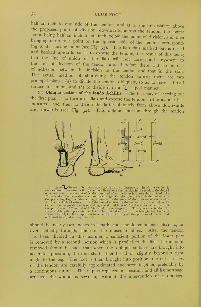 half an inch to one side of the tendon, and at a similar distance above the proposed point of division, downwards, across the tendon, the lowest point being half an inch to an inch below the point of division, and then bringing it up to a point on the opposite side of the tendon correspond- ing to its starting point (see Fig. 33). The flap thus marked out is raised and hooked upwards so as to expose the tendon, the result of this being that the line of union of the flap will not correspond anywhere to the line of division of the tendon, and therefore there will be no risk of adhesion between the incision in the tendon and that in the skin. The actual method of shortening the tendon varies; there are two principal plans : (a) to divide the tendon obliquely, so as to have a broad surface for union, and (^) to divide it in a T_-shaped manner. (a) Oblique section of the tendo Achillis.—The best way of carrying out the first plan, is to turn up a flap and expose the tendon in the manner just indicated, and then to divide the latter obliquely from above downwards and forwards (see Fig. 34). This oblique incision through the tendon Fig. 35.— L’Shaped Section for Lejjgthening Tendons. In A the tendon is seen exposed by raising a flap ; the dark line shows the incision in the tendon, the dotted ones indicating the amount of tendon removed after the latter has been thus divided. In B the tendon has been shortened and sewn together; the toes are a little depre.ssed as in the preceding Fig. C shows diagrammatically the steps of the division of the tendon and the methods of suture. In (i) the line of incision in the tendon is c, a^b^d\ when the two ends are separated, incisions along the dotted lines a'd! and d d are made to cut oM the portions a c d b' and d' a' bd (shaded in the diagram). This gives the tendon the shape and length represented in (2). The divided ends are then brought together and sutured as in (3). It is important to remember in cutting off the portions of tendon that dd must be equal in length to cd. should be nearly two inches in length, and should commence close to, or even actually through, some of the muscular fibres. After the tendon has been divided in this manner, a sufficient portion of the lower part is removed by a second incision which is parallel to the first; the amount removed should be such that when the oblique surfaces are brought into accurate apposition, the foot shall either be at or slightly beyond a right angle to the leg. The foot is then brought into position, the cut surfaces of the tendon are carefully approximated and sewn together, preferably by a continuous suture. The flap is replaced in position and all haemorrhage arrested, the wound is sewn up without the intervention of a drainage