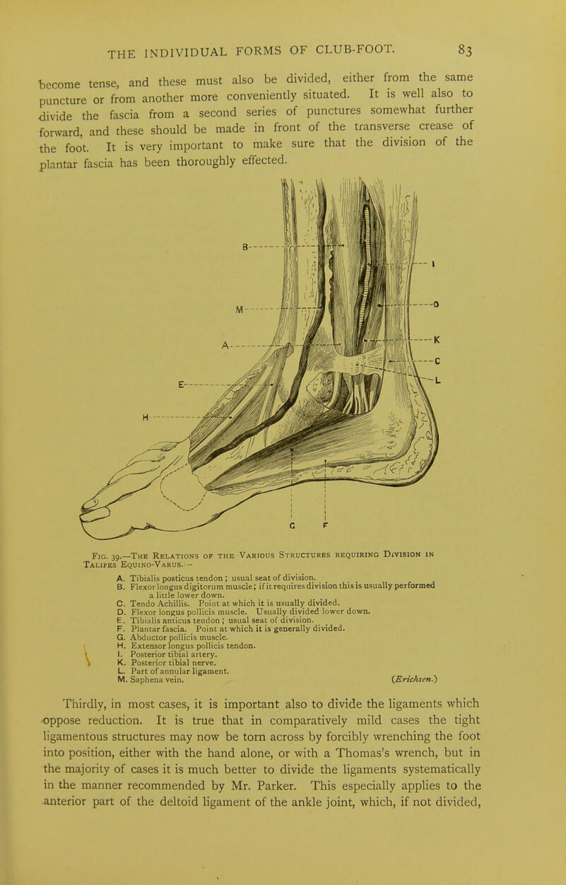 become tense, and these must also be divided, either from the same puncture or from another more conveniently situated. It is well also to divide the fascia from a second series of punctures somewhat further forward, and these should be made in front of the transverse crease of the foot. It is very important to make sure that the division of the plantar fascia has been thoroughly effected. a little lower down. C. Tendo Achillis. Point at which it is usually divided. D. Flexor longus pollicis muscle. Usually divided lower down. E. Tibialis anticus tendon ; usual seat of division. F. Plantar fascia. Point at which it is generally divided. G. Abductor pollicis muscle. \ H. Extensor longus pollicis tendon. I I. Posterior tibial artery. ) K. Posterior tibial nerve. L. Part of annular ligament. M. Saphena vein. {EricJisen.') Thirdly, in most cases, it is important also to divide the ligaments which oppose reduction. It is true that in comparatively mild cases the tight ligamentous structures may now be torn across by forcibly wrenching the foot into position, either with the hand alone, or with a Thomas’s wrench, but in the majority of cases it is much better to divide the ligaments systematically in the manner recommended by Mr. Parker. This especially applies to the anterior part of the deltoid ligament of the ankle joint, which, if not divided.