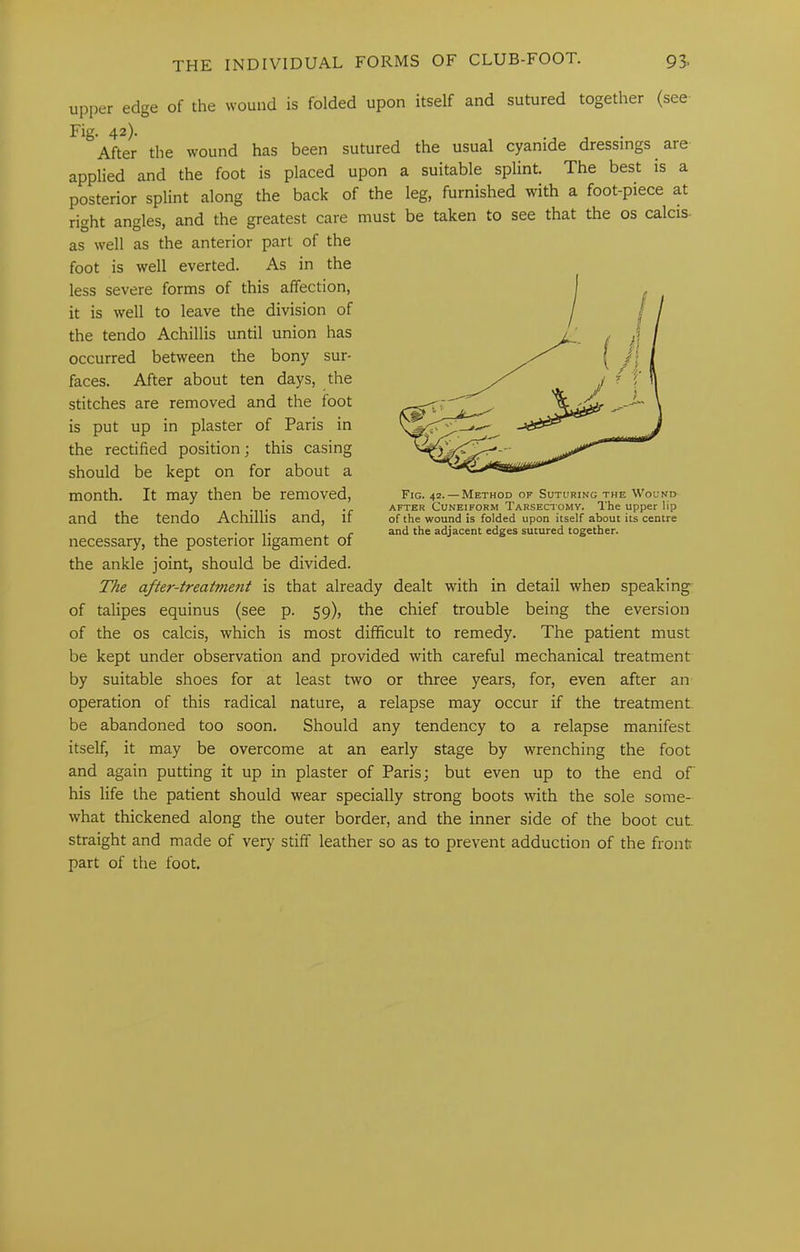 upper edge of the wound is folded upon itself and sutured together (see Fig. 42). After the wound has been sutured the usual cyanide dressings are applied and the foot is placed upon a suitable splint. The best is a posterior splint along the back of the leg, furnished with a foot-piece at right angles, and the greatest care must be taken to see that the os calcis- as well as the anterior part of the foot is well everted. As in the less severe forms of this affection, it is well to leave the division of the tendo Achillis until union has occurred between the bony sur- faces. After about ten days, the stitches are removed and the foot is put up in plaster of Paris in the rectified position; this casing should be kept on for about a month. It may then be removed, and the tendo Achillis and, if necessary, the posterior ligament of the ankle joint, should be divided. The after-treatment is that already dealt with in detail when speaking of talipes equinus (see p. 59), the chief trouble being the eversion of the os calcis, which is most difi&cult to remedy. The patient must be kept under observation and provided with careful mechanical treatment by suitable shoes for at least two or three years, for, even after an operation of this radical nature, a relapse may occur if the treatment be abandoned too soon. Should any tendency to a relapse manifest itself, it may be overcome at an early stage by wrenching the foot and again putting it up in plaster of Paris; but even up to the end of his life the patient should wear specially strong boots with the sole some- what thickened along the outer border, and the inner side of the boot cut straight and made of very stiff leather so as to prevent adduction of the front part of the foot. Fig. 42. — Method of Suturing the Wound AFTER Cuneiform Tarsectomv. The upper lip of the wound is folded upon itself about its centre and the adjacent edges sutured together.