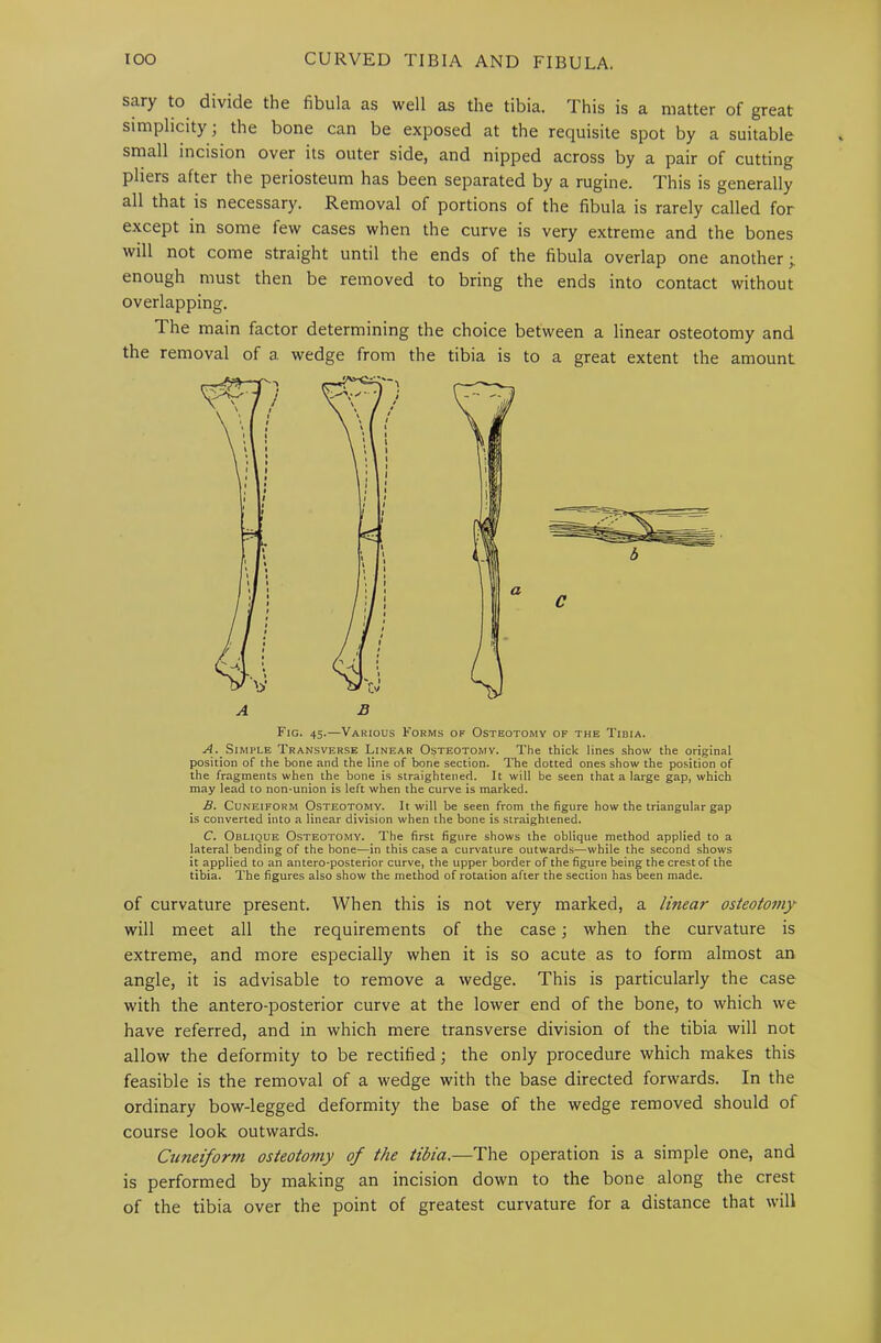 sary to divide the fibula as well as the tibia. This is a matter of great simplicity; the bone can be exposed at the requisite spot by a suitable small incision over its outer side, and nipped across by a pair of cutting pliers after the periosteum has been separated by a rugine. This is generally all that is necessary. Removal of portions of the fibula is rarely called for except in some few cases when the curve is very extreme and the bones will not come straight until the ends of the fibula overlap one another •. enough must then be removed to overlapping. The main factor determining the the removal of a wedge from the bring the ends into contact without choice between a linear osteotomy and tibia is to a great extent the amount Fig. 45.—Various Forms of Osteotomy of the Tibia. ./^. Simple Transverse Linear Osteotomy. The thick lines show the original position of the bone and the line of bone section. The dotted ones show the position of the fragments when the bone is straightened. It will be seen that a large gap, which may lead to non*union is left when the curve is marked. B. Cuneiform Osteotomy. It will be seen from the figure how the triangular gap is converted into a linear division when the bone is straightened. C, Oblique Osteotomy. The first figure shows the oblique method applied to a lateral bending of the hone—in this case a curvature outwards—while the second shows it applied to an antero-posterior curve, the upper border of the figure being the crest of the tibia. The figures also show the method of rotation after the section has been made. of curvature present. When this is not very marked, a linear osteotomy will meet all the requirements of the case; when the curvature is extreme, and more especially when it is so acute as to form almost an angle, it is advisable to remove a wedge. This is particularly the case with the antero-posterior curve at the lower end of the bone, to which we have referred, and in which mere transverse division of the tibia will not allow the deformity to be rectified \ the only procedure which makes this feasible is the removal of a wedge with the base directed forwards. In the ordinary bow-legged deformity the base of the wedge removed should of course look outwards. Cuneiform osteotomy of the tibia.—The operation is a simple one, and is performed by making an incision down to the bone along the crest of the tibia over the point of greatest curvature for a distance that will