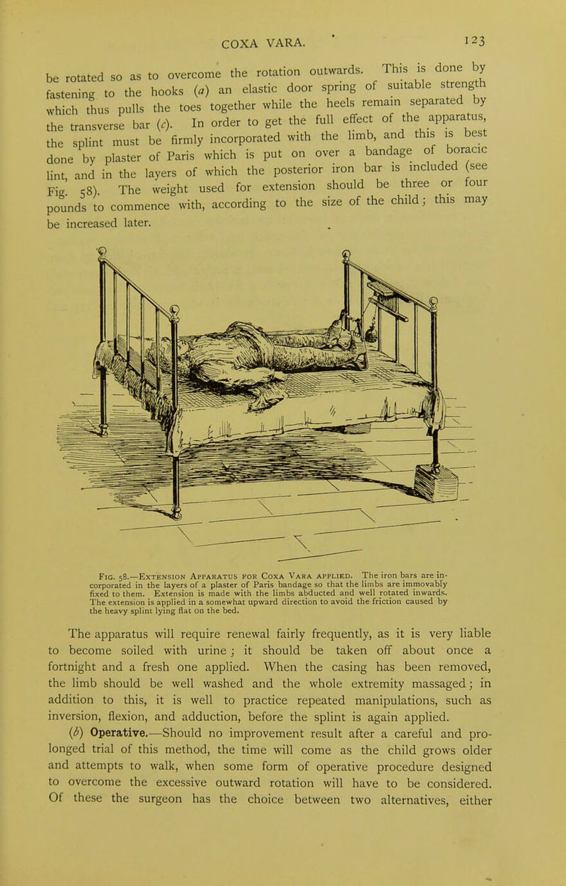 be rotated so as to overcome the rotation outwards. This is done by fastening to the hooks (a) an elastic door spring of suitable s ^^ngth which thus pulls the toes together while the heels remain separated y the transverse bar (.). In order to get the full effect of apparatus the splint must be firmly incorporated with the limb, and this is best done by plaster of Paris which is put on over a bandage of boracic lint and in the layers of which the posterior iron bar is included (see Fig! <^8). The weight used for extension should be three or four pounds to commence with, according to the size of the child; this may be increased later. Fig. 58.—Extension Apparatus for Coxa Vara applied. The iron bars are in- corporated in the layers of a plaster of Paris bandage so that the limbs are immovably fixed to them. Extension is made with the limbs abducted and well rotated inwards. The extension is applied in a somewhat upward direction to avoid the friction caused by the heavy splint lying flat on the bed. The apparatus will require renewal fairly frequently, as it is very liable to become soiled with urine; it should be taken off about once a fortnight and a fresh one applied. When the casing has been removed, the limb should be well washed and the whole extremity massaged; in addition to this, it is well to practice repeated manipulations, such as inversion, flexion, and adduction, before the splint is again applied. {i>) Operative.—Should no improvement result after a careful and pro- longed trial of this method, the time will come as the child grows older and attempts to walk, when some form of operative procedure designed to overcome the excessive outward rotation will have to be considered. Of these the surgeon has the choice between two alternatives, either
