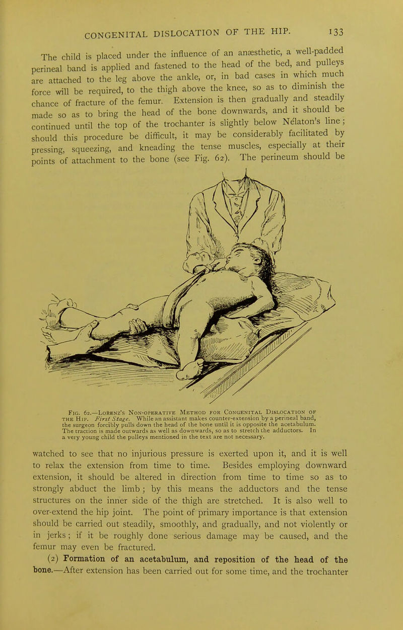 The child is placed under the influence of an anesthetic, a well-padded perineal band is applied and fastened to the head of the bed, and pulleys are attached to the leg above the ankle, or, in bad cases m tvhich much force %vill be required, to the thigh above the knee, so as to dimmish the chance of fracture of the femur. Extension is then gradually and steadily made so as to bring the head of the bone downwards, and it should be continued until the top of the trochanter is slightly below Nekton’s line; should this procedure be difficult, it may be considerably facilitated by pressing, squeezing, and kneading the tense muscles, especially at their points of attachment to the bone (see Fig. 62). The perineum should be Fig. 62.—Lorenz’s Non-operative Method for Congenital Dislocation of THE Hip. First Stage. While an assistant makes counter-extension by a perineal band, the surgeon forcibly pulls down the head of the bone until it is opposite the acetabulum. The traction is made outwards as well as downwards, so as to stretch the adductors. In a very young child the pulleys mentioned in the text are not necessary. watched to see that no injurious pressure is exerted upon it, and it is well to relax the extension from time to time. Besides employing downward extension, it should be altered in direction from time to time so as to strongly abduct the limb; by this means the adductors and the tense structures on the inner side of the thigh are stretched. It is also well to over-extend the hip joint. The point of primary importance is that extension should be carried out steadily, smoothly, and gradually, and not violently or in jerks; if it be roughly done serious damage may be caused, and the femur may even be fractured. (2) Formation of an acetabulum, and reposition of the head of the bone.—After extension has been carried out for some time, and the trochanter