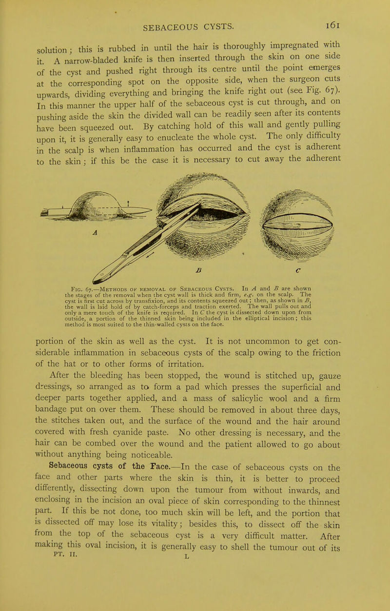 SEBACEOUS CYSTS. solution; this is rubbed in until the hair is thoroughly impregnated wUh it. A narrow-bladed knife is then inserted through the skin on one side of the cyst and pushed right through its centre until the point emerges at the corresponding spot on the opposite side, when the surgeon cuts upwards, dividing everything and bringing the knife right out (see Fig. 67). In this manner the upper half of the sebaceous cyst is cut through, and on pushing aside the skin the divided wall can be readily seen after its contents have been squeezed out. By catching hold of this wall and gently pulling upon it, it is generally easy to enucleate the whole cyst. The only difficulty in the scalp is when inflammation has occurred and the cyst is adherent to the skin; if this be the case it is necessary to cut away the adherent Fig. 67.—Methods ok removal of Sebaceous Cysts. In A and B are shown the stages of the removal when the cyst wall is thick and firm, e.^. on the scalp. The cyst is first cut across by transfixion, and its contents squeezed out then, as shown in B, the wall is laid hold of by catcb-forceps and traction exerted. The wall pulls out and only a mere touch of the knife is required. In C the cyst is dissected down upon from outside, a portion of the thinned skin being included in the elliptical incision; this method is most suited to the thin-walled cysts on the face. portion of the skin as well as the cyst. It is not uncommon to get con- siderable inflammation in sebaceous cysts of the scalp owing to the friction of the hat or to other forms of irritation. After the bleeding has been stopped, the wound is stitched up, gauze dressings, so arranged as to form a pad which presses the superficial and deeper parts together applied, and a mass of salicylic wool and a firm bandage put on over them. These should be removed in about three days, the stitches taken out, and the surface of the wound and the hair around covered with fresh cyanide paste. No other dressing is necessary, and the hair can be combed over the wound and the patient allowed to go about without anything being noticeable. Sebaceous cysts of the Face.—In the case of sebaceous cysts on the face and other parts where the skin is thin, it is better to proceed differently, dissecting down upon the tumour from without inwards, and enclosing in the incision an oval piece of skin corresponding to the thinnest part. If this be not done, too much skin will be left, and the portion that is dissected off may lose its vitality; besides this, to dissect off the skin from the top of the sebaceous cyst is a very difficult matter. After making this oval incision, it is generally easy to shell the tumour out of its PT. II. T,