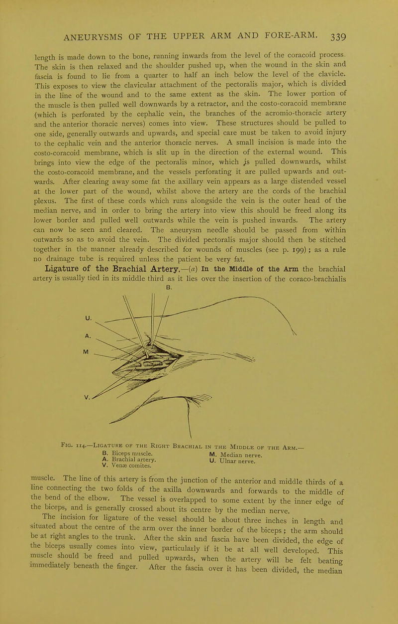 length is made down to the bone, running inwards from the level of the coracoid process. The skin is then relaxed and the shoulder pushed up, when the wound in the skin and fascia is found to lie from a quarter to half an inch below the level of the clavicle. This exposes to view the clavicular attachment of the pectoralis major, which is divided in the line of the wound and to the same extent as the skin. The lower portion of the muscle is then pulled well downwards by a retractor, and the costo-coracoid membrane (which is perforated by the cephalic vein, the branches of the acromio-thoracic artery and the anterior thoracic nerves) comes into view. These structures should be pulled to one side, generally outwards and upwards, and special care must be taken to avoid injury to the cephalic vein and the anterior thoracic nerves. A small incision is made into the costo-coracoid membrane, which is slit up in the direction of the external wound. This brings into view the edge of the pectoralis minor, which ^s pulled downwards, whilst the costo-coracoid membrane, and the vessels perforating it are pulled upwards and out- wards. After clearing away some fat the axillary vein appears as a large distended vessel at the lower part of the wound, whilst above the artery are the cords of the brachial plexus. The first of these cords which runs alongside the vein is the outer head of the median nerve, and in order to bring the artery into view this should be freed along its lower border and pulled well outwards while the vein is pushed inwards. The artery can now be seen and cleared. The aneurysm needle should be passed from within outwards so as to avoid the vein. The divided pectoralis major should then be stitched together in the manner already described for wounds of muscles (see p. 199); as a rule no drainage tube is required unless the patient be very fat. Ligature of tlie Brachial Artery.—(«) in the Middle of the Arm the brachial artery is usually tied in its middle third as it lies over the insertion of the coraco-brachialis B. Fig. 114, Ligature of the Right Brachial in the Middle of the Arm. B. Biceps muscle. M. Median nerve. A. Brachial artery. u. Ulnar nerve. V. Venae comites. muscle. The line of this artery is from the junction of the anterior and middle thirds of a line connecting the two folds of the axilla downwards and forwards to the middle of the bend of the elbow. The vessel is overlapped to some extent by the inner edge of the biceps, and is generally crossed about its centre by the median nerve. The incision for ligature of the vessel should be about three inches in length and situated about the centre of the arm over the inner border of the biceps; the arm should be at right angles to the trunk. After the skin and fascia have been divided, the edge of the biceps usually comes into view, particularly if it be at all well developed. This muscle should be freed and pulled upwards, when the artery will be felt beatinn immediately beneath the finger. After the fascia over it has been divided, the median