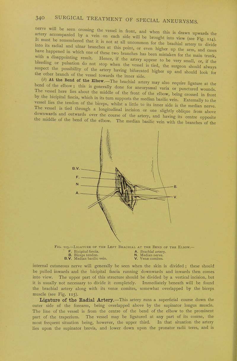 into its radillTnd ’V f®'’ the brachial artery to divide have happened in whilonn? these two^LTches^LTreent\hT;aintrur ^:^i:;p=doL :s^JhitvSirsi;t^j^^ thl^oth } ^*-tery having bifurcated higher up and should look for the other branch of the vessel towards the inner side ben!f^ brachial artery .nay also require ligature at the of the elbovv ; this is generally done for aneurysmal varix or punctured wounds bv th7b • about the middle of the front of the elbow, being crossed in front y the bicipital fascia, which in its turn supports the median basilic vein. Externally to the vessel lies the tendon of the biceps, whilst a little to its inner side is the median nerve le vessel is tied through a longitudinal incision or one slightly oblique from above ownwards and ouU-ards over the course of the artery, and having its centre opposite middle of the bend of the elbow. The median basilic vein with the branches of the Fig. X15.—Ligature of the Left Brachial at the Bend of the Elbow.— F. Bicipital fascia. A. Brachial artery. B. Biceps tendon. N. Median nerve. B.V. Median basilic vein. V. Venae comites. internal cutaneous nerve will generally be seen when the skin is divided; these should be pulled inwards and the bicipital fascia running downwards and inwards then comes into view. The upper part of this structure should be divided by a vertical incision, but it is usually not necessary to divide it completely. Immediately beneath will be found the brachial artery along with its veme comites, somewhat overlapped by the biceps muscle (see Fig. 115). Ligature of the Radial Artery.—This artery runs a superficial course down the outer side of the forearm, being overlapped above by the supinator longus muscle. The line of the vessel is from the centre of the bend of the elbow to the prominent part of the trapezium. The vessel may be ligatured at any part of its course, the most frequent situation being, however, the upper third. In that situation the artery lies upon the supinator brevis, and lower down upon the pronator radii teres, and is