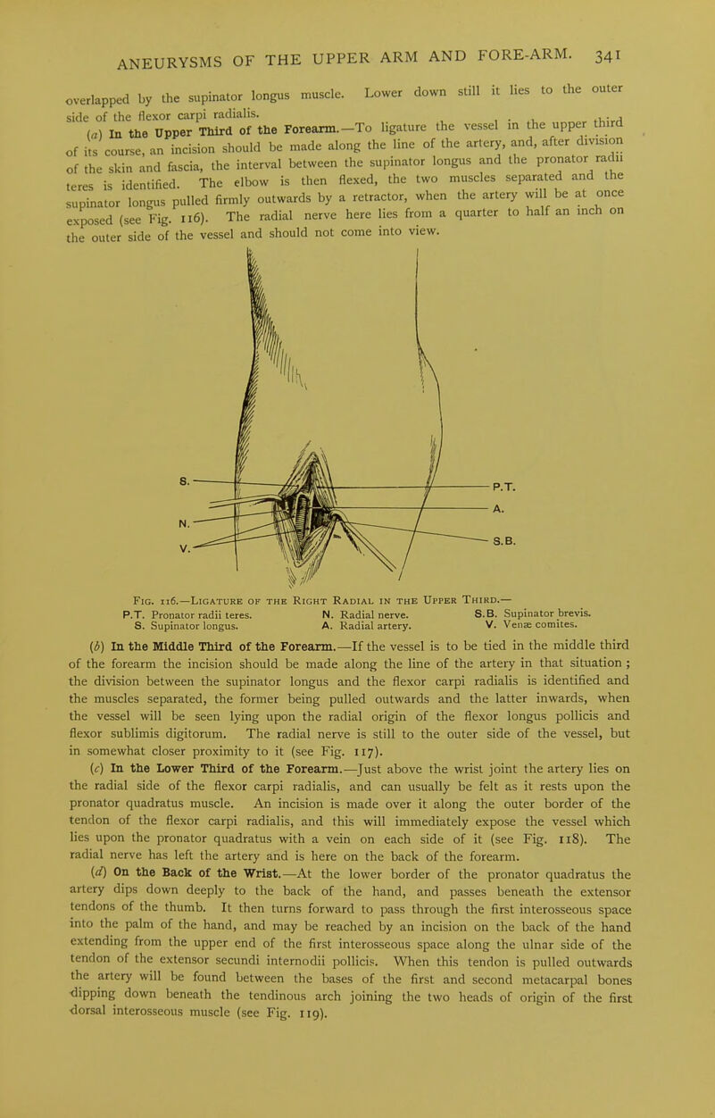 overlapped by the supinator longus muscle. Lower down still it lies to the outer side of the flexor carpi radialis. , . (a) In the Upper Third of the Forearm.—To ligature the vessel in the upper third of its course, an incision should be made along the line of the artery, and, after division of the skin and fascia, the interval between the supinator longus and the pronator radii teres is identified. The elbow is then flexed, the two muscles separated and the supinator longus pulled firmly outwards by a retractor, when the artery will be at once exposed {see Fig. 116). The radial nerve here lies from a quarter to half an inch on the outer side of the vessel and should not come into view. P.T. A. S.B. Fig. 116.—Ligature of the Right Radial in the Upper Third.— P.T. Pronator radii teres. N. Radial nerve. S.B. Supinator brevis. S. Supinator longus. A. Radial artery. V. Venae cotnites. (d) In the Middle Third of the Forearm.—If the vessel is to be tied in the middle third of the forearm the incision should be made along the line of the artery in that situation ; the division between the supinator longus and the flexor carpi radialis is identified and the muscles separated, the former being pulled outwards and the latter inwards, when the vessel will be seen lying upon the radial origin of the flexor longus pollicis and flexor sublimis digitorum. The radial nerve is still to the outer side of the vessel, but in somewhat closer proximity to it (see Fig. 117). {c) In the Lower Third of the Forearm. ^—^Just above the wrist joint the artery lies on the radial side of the flexor carpi radialis, and can usually be felt as it rests upon the pronator quadratus muscle. An incision is made over it along the outer border of the tendon of the flexor carpi radialis, and this will immediately expose the vessel which lies upon the pronator quadratus with a vein on each side of it (see Fig. 118). The radial nerve has left the artery and is here on the back of the forearm. {d) On the Back of the Wrist.—At the lower border of the pronator quadratus the artery dips down deeply to the back of the hand, and passes beneath the extensor tendons of the thumb. It then turns forward to pass through the first interosseous space into the palm of the hand, and may be reached by an incision on the back of the hand extending from the upper end of the first interosseous space along the ulnar side of the tendon of the extensor secundi internodii pollicis. When this tendon is pulled outwards the artery will be found between the bases of the first and second metacarpal bones ■dipping down beneath the tendinous arch joining the two heads of origin of the first ■dorsal interosseous muscle (see Fig. 119).