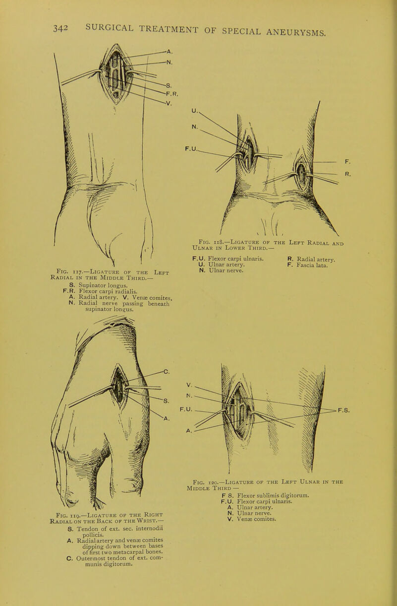 S. Supinator longus. F.R. Flexor carpi radialis. A. Radial artery. V. Vense comites. N. Radial nerve passing beneath supinator longus. Fig. ii8.—Ligature of the Left Radial an Ulnar in Lower Third.— D F. R. F.U. Flexor carpi ulnaris. R. Radial arterj'. U. Ulnar artery. F. Fascia lata. N. Ulnar nerve. Fig. iig.—Ligature of the Right Radial on the Back of the Wrist.— Fig. I2C.—Ligature of the Left Ulnar in the Middle Third — F S. Flexor sublimis digitorum. F.U. Fle.xor carpi ulnaris. A. Ulnar artery. N. Ulnar nerve. V. Venas comites. S. Tendon of ext. sec. internodii pollicis. A. Radial artery and venm comites dipping down between bases of first two metacarpal bones. C. Outermost tendon of ext. com- munis digitorum. k