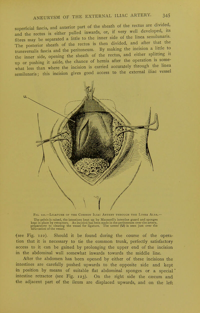 superficial fascia, and anterior part of the sheath of the rectus are divided and the rectus is either pulled inwards, or, if very well developed, its fibres may be separated a little to the inner side of the linea semilunaris. The posterior sheath of the rectus is then divided, and after that t e transversahs fascia and the peritoneum. By making the incision a little to the inner side, opening the sheath of the rectus, and either splitting it up or pushing it aside, the chance of hernia after the operation is some- what less than where the incision is carried accurately through the hnea semilunaris; this incision gives good access to the external iliac vessel Fig. 121.—Ligature of the Common Iliac Artery through the Linea Alba.— The pelvis is raised, the intestines kept up by Maunsell’s intestine guard and sponges kept in place by retractors. An incision has been made in the peritoneum over the artery, preparatory to clearing the vessel for ligature. The ureter (U) is seen just over the bifurcation of the vessel. (see Fig. 122). Should it be found during the course of the opera- tion that it is necessary to tie the common trunk, perfectly satisfactory access to it can be gained by prolonging the upper end of the incision in the abdominal wall somewhat inwards towards the middle line. After the abdomen has been opened by either of these incisions the intestines are carefully pushed upwards to the opposite side and kept in position by means of suitable flat abdominal sponges or a special * intestine retractor (see Fig. 123). On the right side the caecum and the adjacent part of the ileum are displaced upwards, and on the left