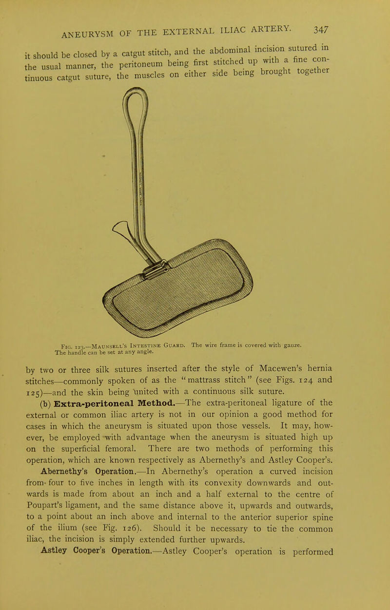 it should be closed by a catgut stitch, and the abdomtnal ™ the usual manner, the peritoneum being first stttched up with a fine con tinuous catgut suture, the muscles on either side being brought toge Fig. 123. Maunsell’s Intestine Guard. The wire frame is covered with gauze. The handle can be set at any angle. by two or three silk sutures inserted after the style of Macewen’s hernia stitches—commonly spoken of as the “ mattrass stitch” (see Figs. 124 and 125)—and the skin being united with a continuous silk suture. (b) Extra-peritoneal Method.—The extra-peritoneal ligature of the external or common iliac artery is not in our opinion a good method for cases in which the aneurysm is situated upon those vessels. It may, how- ever, be employed 'with advantage when the aneurysm is situated high up on the superficial femoral. There are two methods of performing this operation, which are known respectively as Abernethy’s and Astley Cooper’s. Abemethy’s Operation.—In Abernethy’s operation a curved incision from* four to five inches in length with its convexity downwards and out- wards is made from about an inch and a half external to the centre of Poupart’s ligament, and the same distance above it, upwards and outwards, to a point about an inch above and internal to the anterior superior spine of the ilium (see Fig. 126). Should it be necessary to tie the common iliac, the incision is simply extended further upwards. Astley Cooper’s Operation.—Astley Cooper’s operation is performed