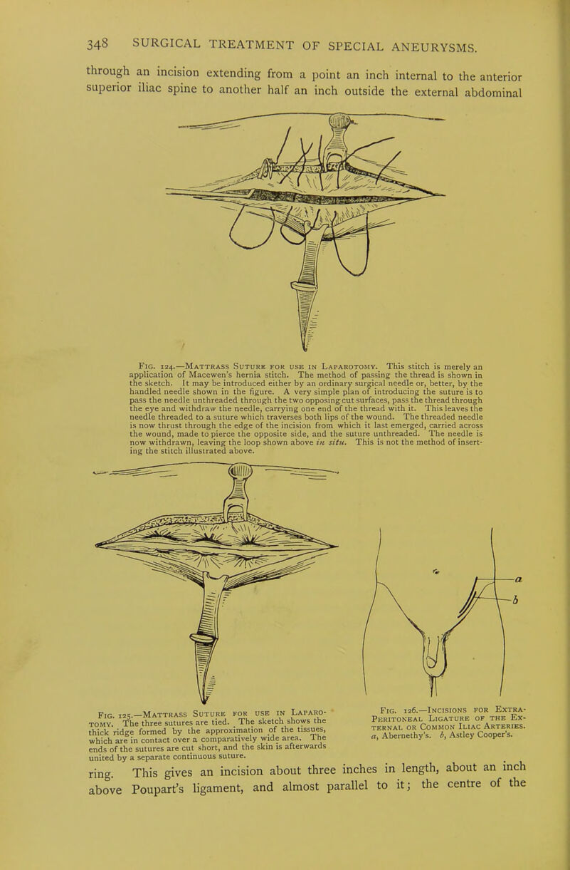 through an incision extending from a point an inch internal to the anterior superior iliac spine to another half an inch outside the external abdominal Fig. 124.—Mattrass Suture for use in Laparotomy. This stitch is merely an application of Macewen’s hernia stitch. The method of pas.sing the thread is shown in the sketch. It may be introduced either by an ordinary surgical needle or, better, by the handled needle shown in the figure. A very simple plan of introducing the suture is to pass the needle unthreaded through the two opposing cut surfaces, pass the thread through the eye and withdraw the needle, carrying one end of the thread with it. This leaves the needle threaded to a suture which traverses both lips of the wound. The threaded needle is now thrust through the edge of the incision from which it last emerged, carried across the wound, made to pierce the opposite side, and the suture unthreaded. The needle is now withdrawn, leaving the loop shown above hi situ* This is not the method of insert- ing the stitch illustrated above.
