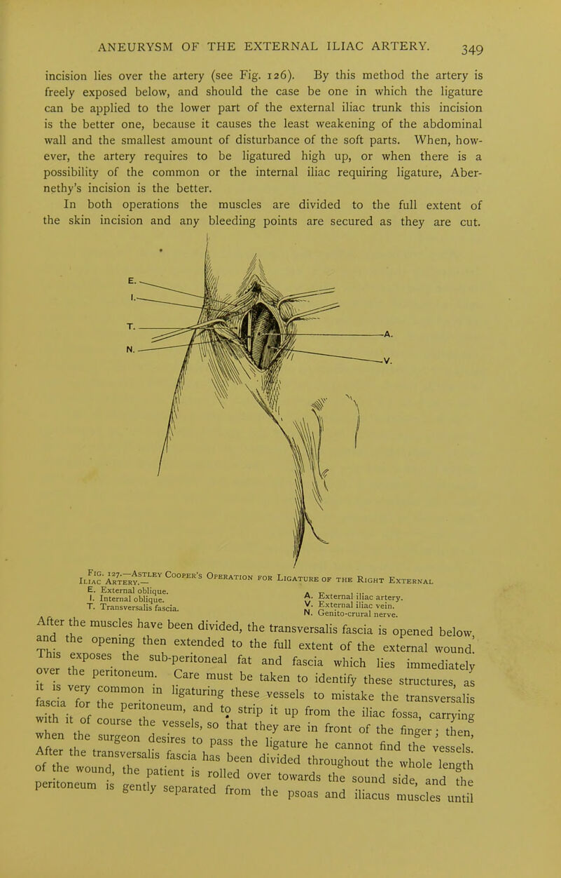 incision lies over the artery (see Fig. 126). By this method the artery is freely exposed below, and should the case be one in which the ligature can be applied to the lower part of the external iliac trunk this incision is the better one, because it causes the least weakening of the abdominal wall and the smallest amount of disturbance of the soft parts. When, how- ever, the artery requires to be ligatured high up, or when there is a possibility of the common or the internal iliac requiring ligature, Aber- nethy’s incision is the better. In both operations the muscles are divided to the full extent of the skin incision and any bleeding points are secured as they are cut. E. External oblique. I. Internal oblique. T. Transversalis fascia. A. External iliac artery. V. Extwnal iliac vein. N. Genito-crural nerve. vjcuiLu-crurai nerve. '’‘T' fascia is opened below, and the opening then extended to the full extent of the external wound. over fat and fascia which lies immediately it is ver t^ken to identify these structures, as fascia for the”ne°r> to mistake the transversalis wTh it of “P *e iliac fossa, carrying with ,t of course the vessels, so that they are in front of the finger • thin After the^t™^*'™ “ P“® ligature he cannot find the vessels’ After the transversahs fascia has been divided throughout the whole length of the wound, the patient is rolled over towards the sound side and S peritoneum is gently senantPrl , auuuu siae, and the S y parated from the psoas and iliacus muscles until