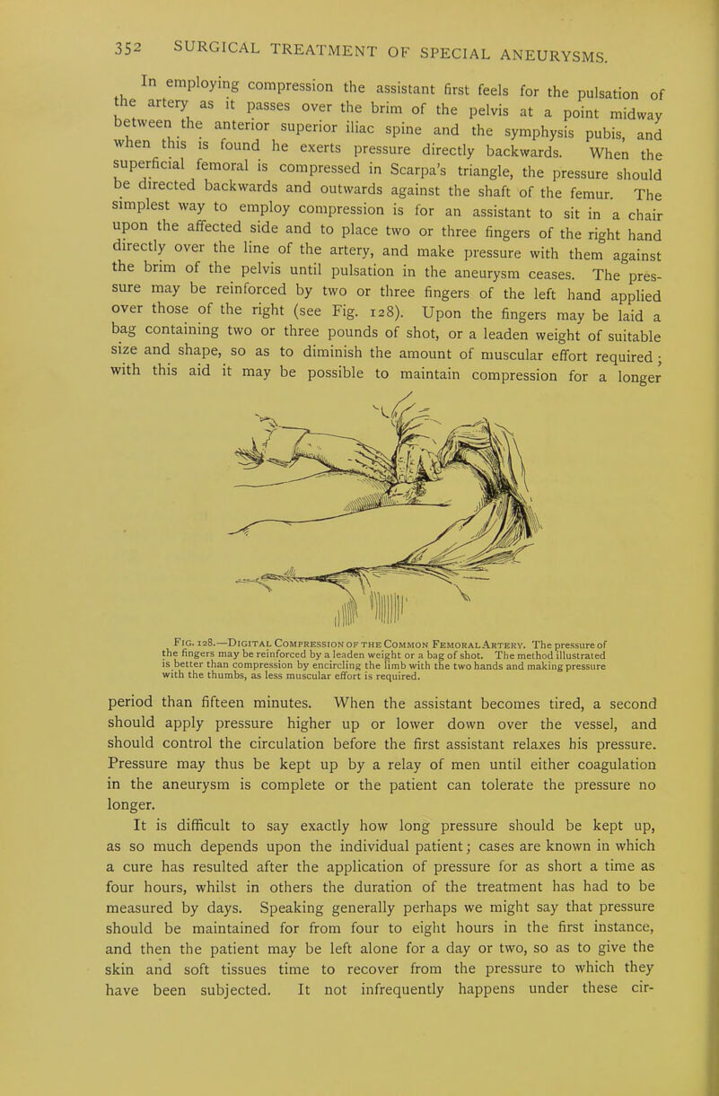 In employing compression the assistant first feels for the pulsation of the artery as it passes over the brim of the pelvis at a point midway between the anterior superior iliac spine and the symphysis pubis, and when this is found he exerts pressure directly backwards. When the superficial femoral is compressed in Scarpa’s triangle, the pressure should be directed backwards and outwards against the shaft of the femur. The simplest way to employ compression is for an assistant to sit in a chair upon the affected side and to place two or three fingers of the right hand directly over the line of the artery, and make pressure with them against the brim of the pelvis until pulsation in the aneurysm ceases. The pres- sure may be reinforced by two or three fingers of the left hand applied over those of the right (see Fig. 128). Upon the fingers may be laid a bag containing two or three pounds of shot, or a leaden weight of suitable size and shape, so as to diminish the amount of muscular effort required • with this aid it may be possible to maintain compression for a longer Fig. 128.—Digital Compression of the Common Femoral Artery. The pressure of the fingers may be reinforced by a leaden weight or a bag of shot. The method illustrated is better than compression by encircling the limb with the two hands and making pressure with the thumbs, as less muscular effort is required. period than fifteen minutes. When the assistant becomes tired, a second should apply pressure higher up or lower down over the vessel, and should control the circulation before the first assistant relaxes his pressure. Pressure may thus be kept up by a relay of men until either coagulation in the aneurysm is complete or the patient can tolerate the pressure no longer. It is difficult to say exactly how long pressure should be kept up, as so much depends upon the individual patient; cases are known in which a cure has resulted after the application of pressure for as short a time as four hours, whilst in others the duration of the treatment has had to be measured by days. Speaking generally perhaps we might say that pressure should be maintained for from four to eight hours in the first instance, and then the patient may be left alone for a day or two, so as to give the skin and soft tissues time to recover from the pressure to which they have been subjected. It not infrequently happens under these cir-