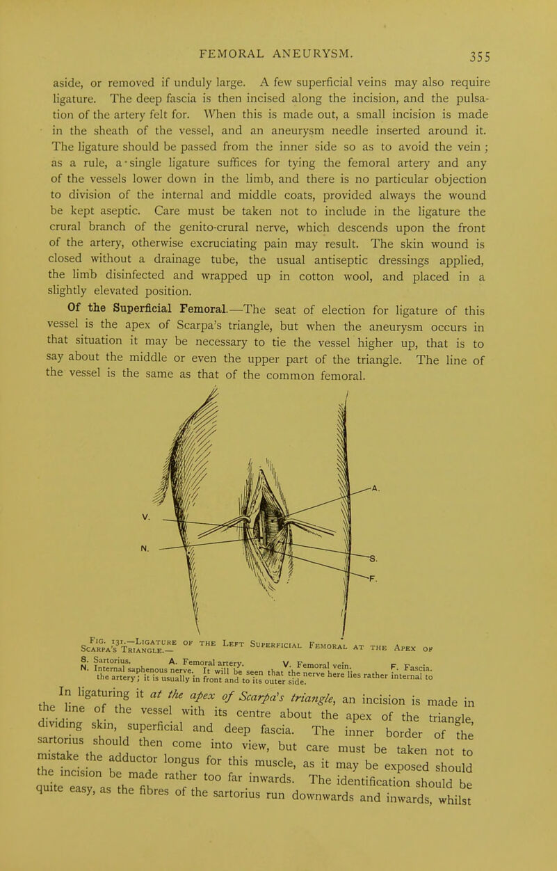 aside, or removed if unduly large. A few superficial veins may also require ligature. The deep fascia is then incised along the incision, and the pulsa- tion of the artery felt for. When this is made out, a small incision is made in the sheath of the vessel, and an aneurysm needle inserted around it. The ligature should be passed from the inner side so as to avoid the vein ; as a rule, a-single ligature suffices for tying the femoral artery and any of the vessels lower down in the limb, and there is no particular objection to division of the internal and middle coats, provided always the wound be kept aseptic. Care must be taken not to include in the ligature the crural branch of the genito-crural nerve, which descends upon the front of the artery, otherwise e.\cruciating pain may result. The skin wound is closed without a drainage tube, the usual antiseptic dressings applied, the limb disinfected and wrapped up in cotton wool, and placed in a slightly elevated position. Of the Superficial Femoral.—The seat of election for ligature of this vessel is the apex of Scarpa’s triangle, but when the aneurysm occurs in that situation it may be necessary to tie the vessel higher up, that is to say about the middle or even the upper part of the triangle. The line of the vessel is the same as that of the common femoral. 8. Sartorius. A. Femoral artery. V. Femoral vein theT'V ‘hat the nerve herTli the artery, it is usually in front and to its outer side. F. Fascia, rather internal to In l,ga,unng at the apex of Scarpa's triangle, an incision is made in the line of the vessel with its centre about the apex of the triangle dividing skin superficial and deep fascia. The inner border of Ae sartorius should then come into view, but care must be taken not to mistake *e adductor longus for this muscle, as it may be exposed should quiteTsy as Arfih' ^he identificatiL should be quite easy, as the fibres of the sartorius run downwards and inwards, whilst