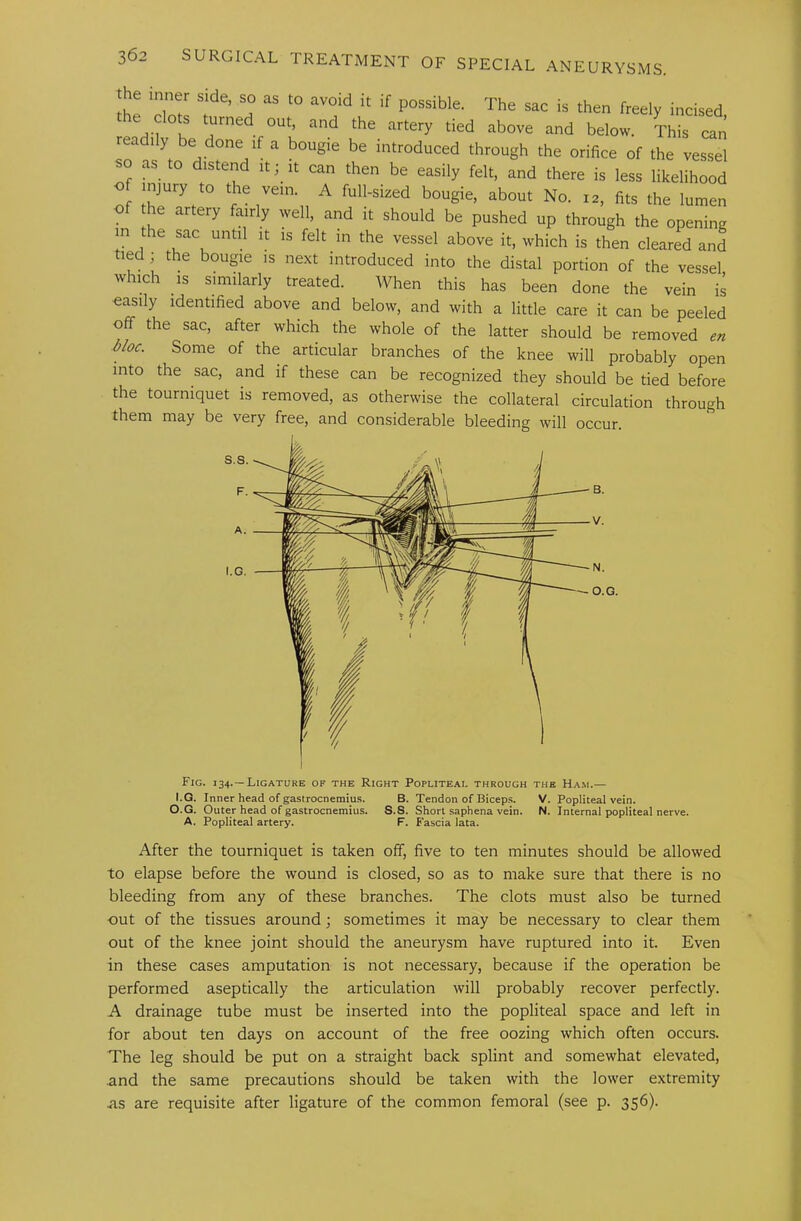 he inner side, so as to avoid it if possible. The sac is then freely incised the clots turned out, and the artery tied above and below. Th\s can readily be done if a bougie be introduced through the orifice of the vessel so as to distend it it can then be easily felt, and there is less likelihood injury to the vein. A full-sized bougie, about No. 12, fits the lumen of he artery fairly well, and it should be pushed up through the opening in the sac until it is felt m the vessel above it, which is then cleared and tied ; the bougie is next introduced into the distal portion of the vessel which is similarly treated. When this has been done the vein is oasily identified above and below, and with a little care it can be peeled off the sac, after which the whole of the latter should be removed en bloc. Some of the articular branches of the knee will probably open into the sac, and if these can be recognized they should be tied before the tourniquet is removed, as otherwise the collateral circulation through them may be very free, and considerable bleeding will occur. Fig. 134. —Ligature of the Right Popliteal through the Ha.m.— I.G. Inner head of gastrocnemius. B. Tendon of Biceps. V. Popliteal vein. O.G. Outer head of gastrocnemius. S.S. Short saphena vein. N. Internal popliteal nerve. A. Popliteal artery. F. Fascia lata. After the tourniquet is taken off, five to ten minutes should be allowed to elapse before the wound is closed, so as to make sure that there is no bleeding from any of these branches. The clots must also be turned out of the tissues around; sometimes it may be necessary to clear them out of the knee joint should the aneurysm have ruptured into it. Even in these cases amputation is not necessary, because if the operation be performed aseptically the articulation will probably recover perfectly. A drainage tube must be inserted into the popliteal space and left in for about ten days on account of the free oozing which often occurs. The leg should be put on a straight back splint and somewhat elevated, .and the same precautions should be taken with the lower extremity as are requisite after ligature of the common femoral (see p. 356).