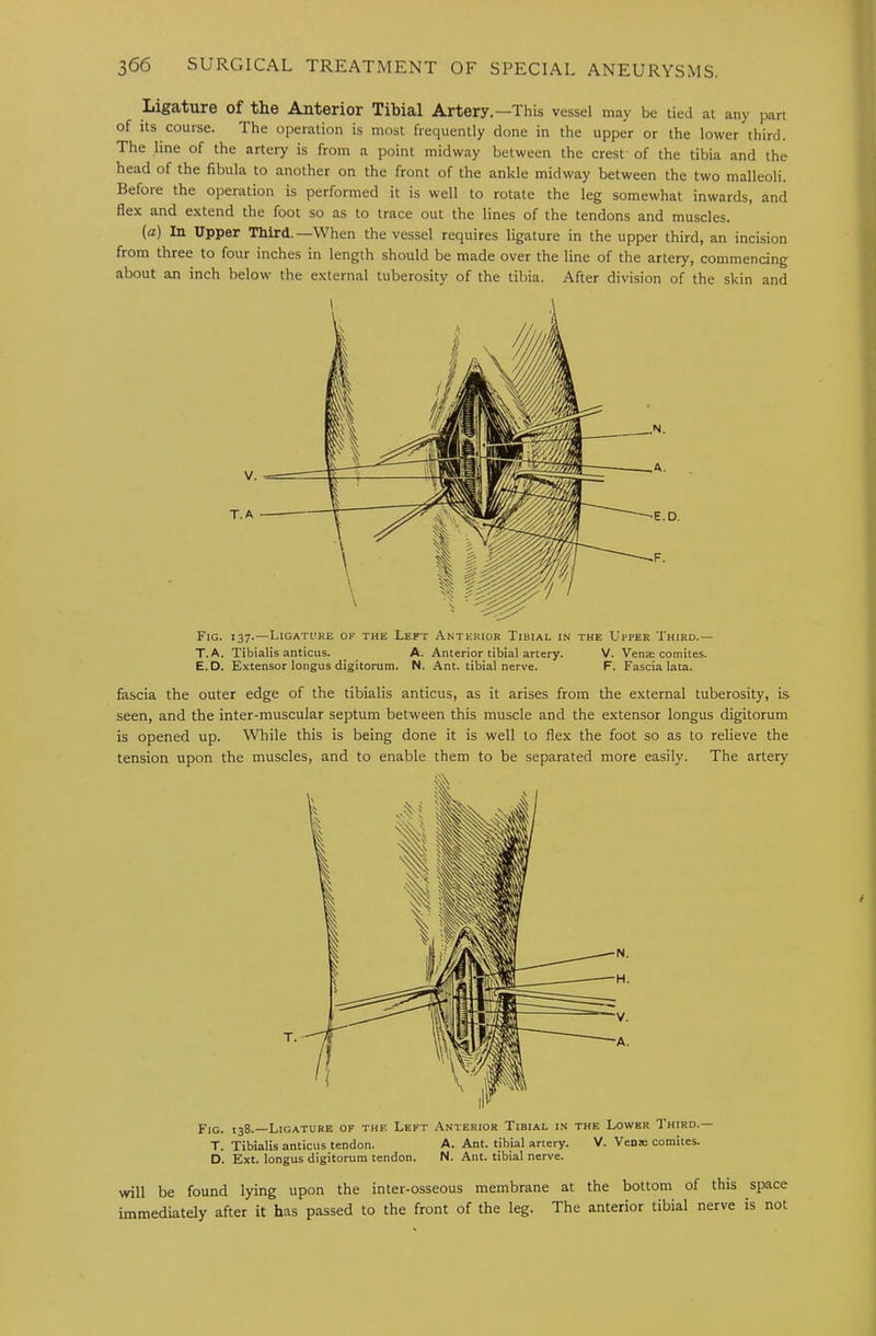 Ligature of the Anterior Tibial Artery,—This vessel may be tied at any part of its course. The operation is most frequently done in the upper or the lower third. The line of the artery is from a point midway between the crest of the tibia and the head of the fibula to another on the front of the ankle midway between the two malleoli. Before the operation is performed it is well to rotate the leg somewhat inwards, and flex and extend the foot so as to trace out the lines of the tendons and muscles. (a) In Upper Third.—When the vessel requires ligature in the upper third, an incision from three to four inches in length should be made over the line of the artery, commencing about an inch below the external tuberosity of the tibia. After division of the skin and Fig. 137.—Ligature of the Left Anterior Tibiae in the Upper Third.— T. A. Tibialis anticus. A. Anterior tibial artery. V. Venae comites. E.D. Extensor longus digitorum. N. Ant. tibial nerve. F. Fascia lata. fascia the outer edge of the tibialis anticus, as it arises from the external tuberosity, is seen, and the inter-muscular septum between this muscle and the extensor longus digitorum is opened up. While this is being done it is well to flex the foot so as to relieve the tension upon the muscles, and to enable them to be separated more easily. The artery Fig. 138.—Ligature of the Left Anterior Tibiae in the Lower Third.— T. Tibialis anticus tendon. A. Ant. tibial artery. V. Venie comites. D. Ext. longus digitorum tendon. N. Ant. tibial nerve. will be found lying upon the inter-osseous membrane at the bottom of this space immediately after it has passed to the front of the leg. The anterior tibial nerve is not