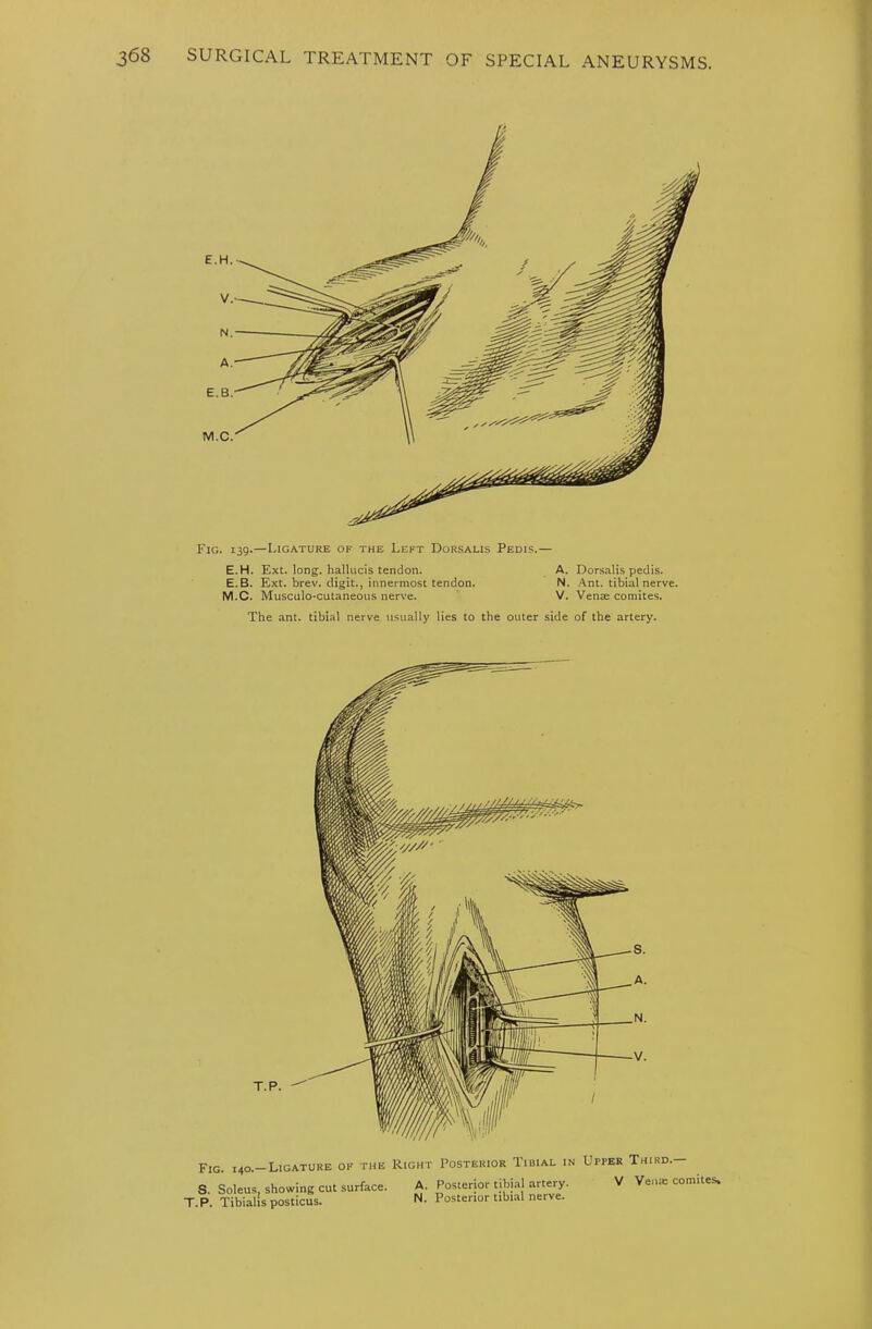 Fig. 139.—Ligature of the Left Dorsalis Pedis.— E.H. Ext. long, hallucis tendon. A. Dorsalis pedis. E.B. Ext. brev. digit., innermost tendon. N. .Ant. tibial nerve. M.C. Musculo-cutaneous nerve. V. Vense comites. The ant. tibial nerve usually lies to the outer side of the artery. Fig. 140.—Ligature of the Right Posterior Iidial in S. Soleus, showing cut surface. T.P. Tibialis posticus. A. Posterior tibial artery. N. Posterior tibi.al nerve. UrPER Third.— V Veum comites.