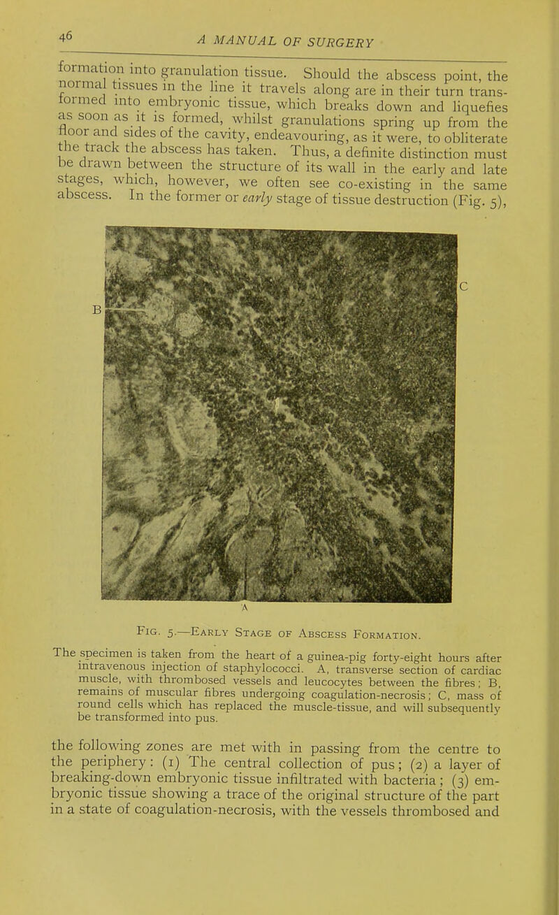 formation into gianulation tissue. Should the abscess point, the 1101 ma issues in the line it travels along are in their turn trans- tormed into embryonic tissue, which breaks down and liquefies as soon as It is formed, whilst granulations spring up from the Hoor and sides of the cavity, endeavouring, as it were, to obliterate le track the abscess has taken. Thus, a definite distinction must be drawn between the structure of its wall in the early and late stages, which, however, we often see co-existing in the same abscess. In the former or early stage of tissue destruction (Fig. 5), Fig. 5. Early Stage of Abscess Formation. The specimen is taken from the heart of a guinea-pig forty-eight hours after intravenous injection of staphylococci. A, transverse section of cardiac muscle, with thrombosed vessels and leucocytes between the fibres; B, remains of muscular fibres undergoing coagulation-necrosis; C, mass of round cells which has replaced the muscle-tissue, and will subsequently be transformed into pus. the follovdng zones are met with in passing from the centre to the periphery; (i) The central collection of pus; (2) a layer of breaking-down embryonic tissue infiltrated with bacteria ; (3) em- bryonic tissue showing a trace of the original structure of the part in a state of coagulation-necrosis, with the vessels thrombosed and