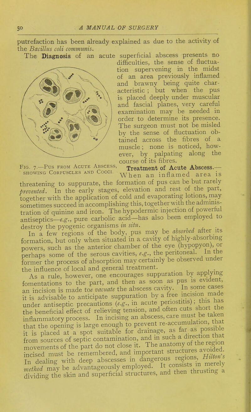 Fig. 7.—Pds from Acute Abscess SHOWING Corpuscles and Cocci. putrefaction has been already explained as due to the activity of the Bacillus coli communis. The Diagnosis of an acute superficial abscess presents no difficulties, the sense of fluctua- tion supervening in the midst of an area previously inflamed and brawny being quite char- acteristic ; but when the pus is placed deeply under muscular and fascial planes, very careful examination may be needed in order to determine its presence. The surgeon must not be misled by the sense of fluctuation ob- tained across the fibres of a muscle; none is noticed, how- ever, by palpating along the course of its fibres. Treatment of Acute Abscess.— When an inflamed area is threatening to suppurate, the formation of pus can be but rarely prevented. In the early stages, elevation and rest of the part, together with the application of cold and evaporating lotions, rnay sometimes succeed in accomplishing this, together with the adminis- tration of quinine and iron. The hypodermic injection of powerful antiseptics—e.g., pure carbolic acid—has also been employed to destroy the pyogenic organisms in siUi. , , 7 r^. n In a few regions of the body, pus may be absorbed alter its formation, but only when situated in a cavity of high y a sor ing powers, such as the anterior chamber of the eye (hypopyon) or perhaps some of the serous cavities, e.g., the peritoneal, in the former the process of absorption may certainly be observed under the influence of local and general treatment. As a rule, however, one encourages suppuration by applying fomentations to the part, and then as soon as pus is ’ an incision is made toe vacuate the abscess cavity, in some cases it is advisable to anticipate suppuration by a under antiseptic precautions (e.g., in acute periostitis) ; t^ has the beneficial effect of relieving tension, and often cuts short the inflammatory process. In incising an abscess, caie mus ^ that the opening is large enough to prevent re-accumulation that it is placed at a spot%uitable for drainage, as as possibffi from Lurces of septic contamination, and in such a movements of the part do not close it. The anatomy of the region incised must be remembered, and important structmes ^ ff in dealine with deep abscesses m dangerous legions, mnons mly be advjtageously employed. I. dividing the skin and superficial structures, and then thrustin^