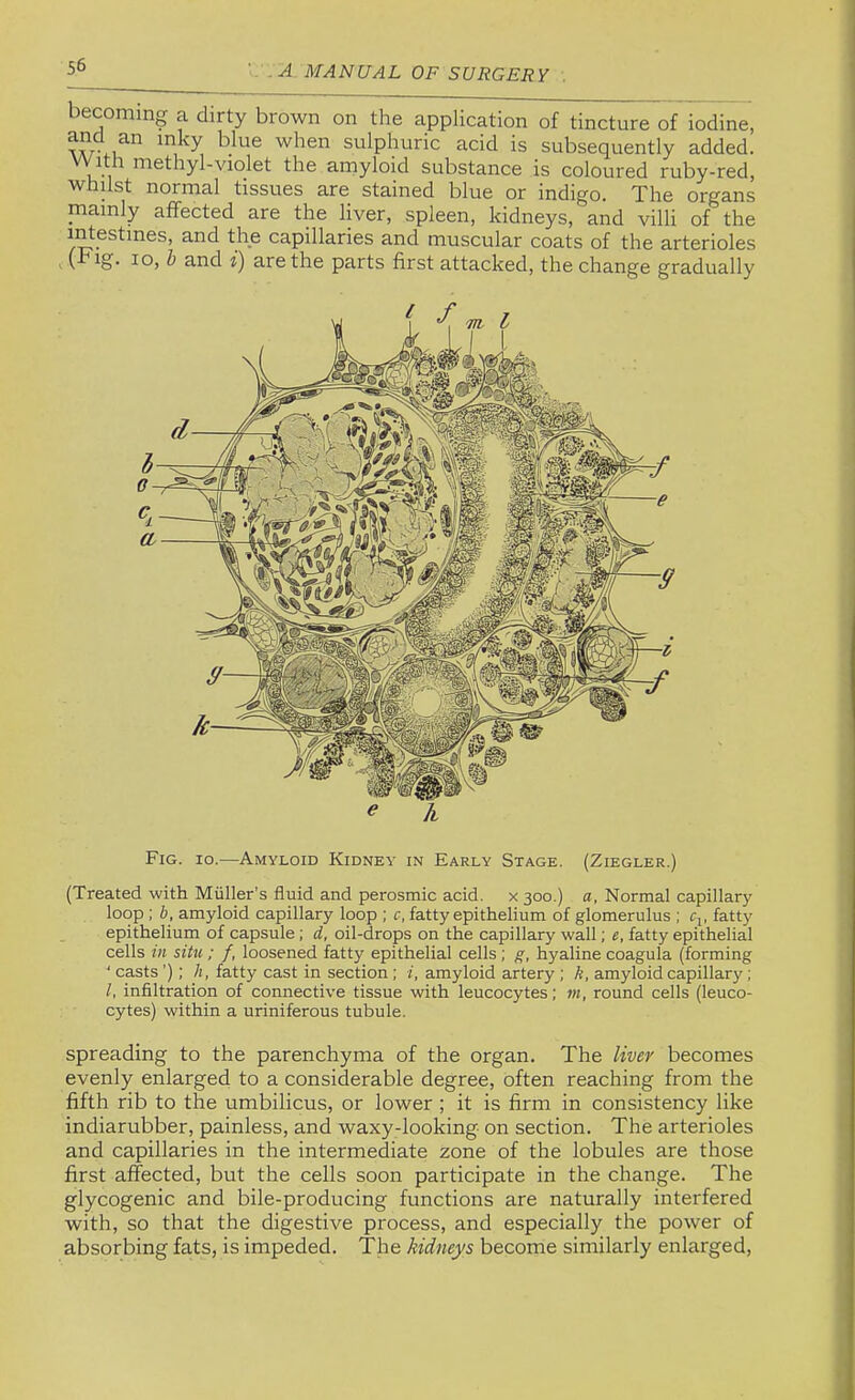 becoming a dirty brown on the application of tincture of iodine, sulphuric acid is subsequently added. With methyl-violet the amyloid substance is coloured ruby-red, whilst normal tissues are stained blue or indigo. The organs mainly affected are the liver, spleen, kidneys, and villi of the intestines, and the capillaries and muscular coats of the arterioles t b and f) are the parts first attacked, the change gradually Fig. 10.—Amyloid Kidney in Early Stage. (Ziegler.) (Treated with Muller’s fluid and perosmic acid, x 300.) a, Normal capillary loop ; b, amyloid capillary loop ; c, fatty epithelium of glomerulus ; q, fatty epithelium of capsule; d, oil-drops on the capillary wall; e, fatty epithelial cells in situ; f, loosened fatty epithelial cells ; g, hyaline coagula (forming ' casts ’); h, fatty cast in section ; i, amyloid artery ; k, amyloid capillary; I, infiltration of connective tissue with leucocytes; m, round cells (leuco- cytes) within a uriniferous tubule. spreading to the parenchyma of the organ. The liver becomes evenly enlarged to a considerable degree, often reaching from the fifth rib to the umbilicus, or lower ; it is firm in consistency like indiarubber, painless, and waxy-looking on section. The arterioles and capillaries in the intermediate zone of the lobules are those first affected, but the cells soon participate in the change. The glycogenic and bile-producing functions are naturally interfered with, so that the digestive process, and especially the power of absorbing fats, is impeded. The kidneys become similarly enlarged.