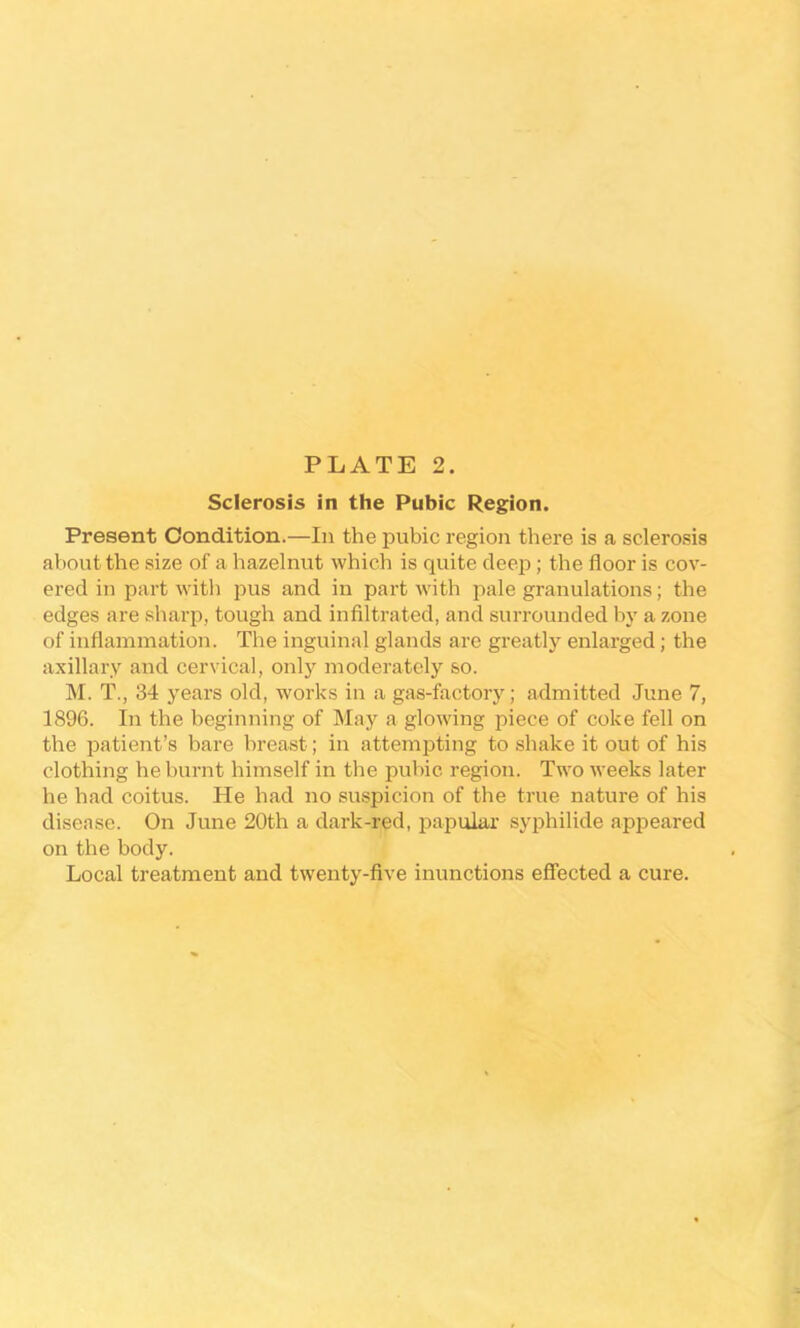 Sclerosis in the Pubic Region. Present Condition.—In the pubic region there is a sclerosis about the size of a hazelnut which is quite deep; the floor is cov- ered in part with pus and in part with pale granulations; the edges are sharp, tough and infiltrated, and surrounded by a zone of inflammation. The inguinal glands are greatly enlarged; the axillary and cervical, only moderately so. M. T., 34 years old, works in a gas-factory; admitted June 7, 1896. In the beginning of Ma}'^ a glowing piece of coke fell on the patient’s bare breast; in attempting to shake it out of his clothing he burnt himself in the pubic region. Two weeks later he had coitus. He had no suspicion of the true nature of his disease. On June 20th a dark-red, papular syphilide appeared on the body. Local treatment and twenty-five inunctions effected a cure.