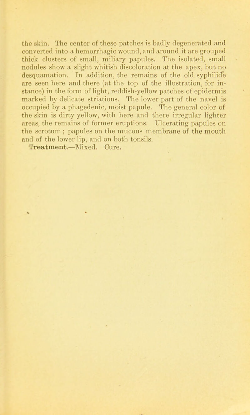 the skin. The center of tliese patches is badly degenerated and converted into a hemorrhagic wound, and around it are grouped thick clusters of small, miliary papules. The isolated, small nodules show a slight whitish discoloration at the apex, but no desquamation. In addition, the remains of the old syphilide are seen here and there (at the top of the illustration, for in- stance) in the form of light, reddish-yellow patches of epidermis marked by delicate striations. The lower part of the navel is occupied by a phagedenic, moist papule. The general color of the skin is dirty yellow, with here and there irregular lighter areas, the remains of former eruptions. Ulcerating papules on the scrotum ; papules on the mucous membrane of the mouth and of the lower lip, and on both tonsils. Treatment.—Mixed. Cure.