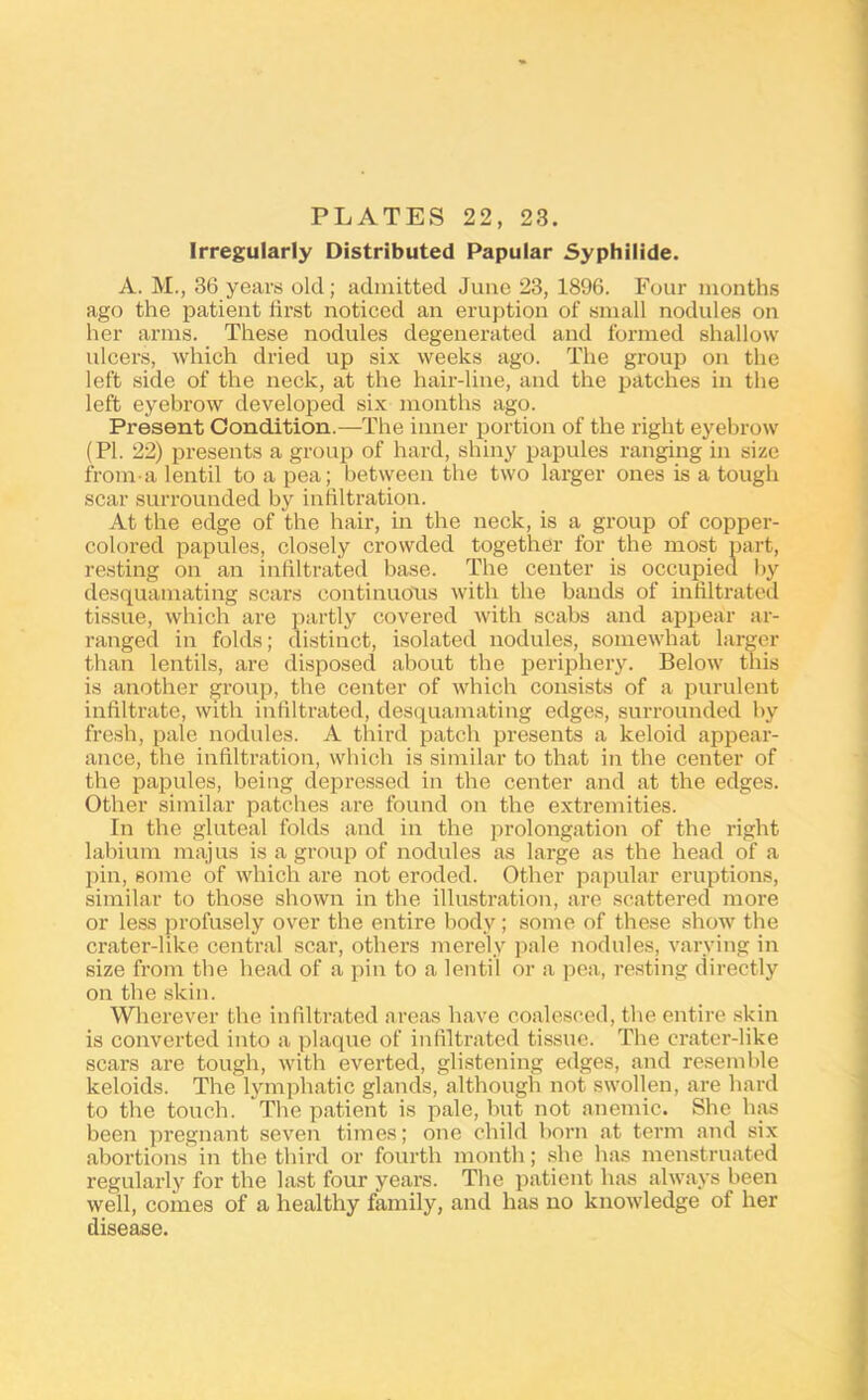 Irregularly Distributed Papular 5yphilide. A. M., 36 years old; admitted June 23, 1896. Four months ago the patient iirst noticed an eruption of small nodules on her arms. These nodules degenerated and formed shallow ulcers, which dried up six weeks ago. The group on the left side of the neck, at the hair-line, and the patches in the left eyebrow developed six months ago. Present Condition.—The inner portion of the right eyebrow (PI. 22) presents a group of hard, shiny papules ranging in size from a lentil to a pea; between the two larger ones is a tough scar surrounded by intiltration. At the edge of the hair, in the neck, is a group of copper- colored papules, closely erowded together for the most part, resting on an infiltrated base. The center is occuj)ied by desquamating scars continuous with the bauds of infiltrateil tissue, which are partly covered Avith scabs and appear ar- ranged in folds; distinct, isolated nodules, somewhat larger than lentils, are disposed about the periphery. Below this is another ^roup, the center of which consists of a purulent infiltrate, with infiltrated, desquamating edges, surrounded by fresh, pale nodules. A third patch presents a keloid apjiear- ance, the infiltration, which is similar to that in the center of the papules, being depressed in the center and at the edges. Other similar patches are found on the extremities. In the gluteal folds and in the prolongation of the right labium majus is a group of nodules <os large as the head of a pin, some of which are not eroded. Other papular eruptions, similar to those shown in the illustration, are scattered more or less profusely over the entire body; some of these shoAV the crater-like central scar, others merely jiale nodules, varying in size from the head of a pin to a lentil or a pea, resting directly on the skin. Wherever the infiltrated areas have coalesced, the entire skin is converted into a plaque of infiltrated tissue. The crater-like scars are tough, with everted, glistening edges, and resemble keloids. The lymphatic glands, although not swollen, are hard to the touch. The patient is pale, but not anemic. She has been pregnant seven times; one child born at term and six abortions in the third or fourth month; she has menstruated regularly for the last four years. The patient has ahvays been well, comes of a healthy family, and has no knoAvledge of her disease.