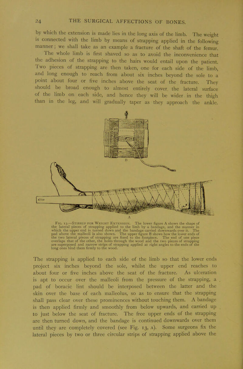 by which the extension is made lies in the long axis of the limb. The weight is connected with the limb by means of strapping applied in the following manner; we shall take as an example a fracture of the shaft of the femur. I he whole limb is first shaved so as to avoid the inconvenience that the adhesion of the strapping to the hairs would entail upon the patient. T wo pieces of strapping are then taken, one for each side of the limb, and long enough to reach from about six inches beyond the sole to a point about four or five inches above the seat of the fracture. They should be broad enough to almost entirely cover the lateral surface of the limb on each side, and hence they will be wider in the thigh than in the leg, and will gradually taper as they approach the ankle. Fig. 13.—Stirrup for Weight Extension. The lower figure A shows the shape of the lateral pieces of strapping applied to the limb by a bandage, and the manner in which the upper end is turned down and the bandage carried downwards over it. The pad above the malleoli is also shown. The upper figure B shows how the lower ends of the two lateral pieces of strapping are fixed to the footpiece. The end of one piece overlaps that of the other, the holes through the wood and the two pieces of strapping are superposed and narrow strips of strapping applied at right angles to the ends of the long ones bind them firmly to the wood. The Strapping is applied to each side of the limb so that the lower ends project six inches beyond the sole, whilst the upper end reaches to about four or five inches above the seat of the fracture. As ulceration is apt to occur over the malleoli from the pressure of the strapping, a pad of boracic lint should be interposed between the latter and the skin over the base of each malleolus, so as to ensure that the strapping shall pass clear over these prominences without touching them. A bandage is then applied firmly and smoothly from below upwards, and carried up to just below the seat of fracture. The free upper ends of the strapping are then turned down, and the bandage is continued downwards over them until they are completely covered (see Fig. 13, a). Some surgeons fix the lateral pieces by two or three circular strips of strapping applied above the