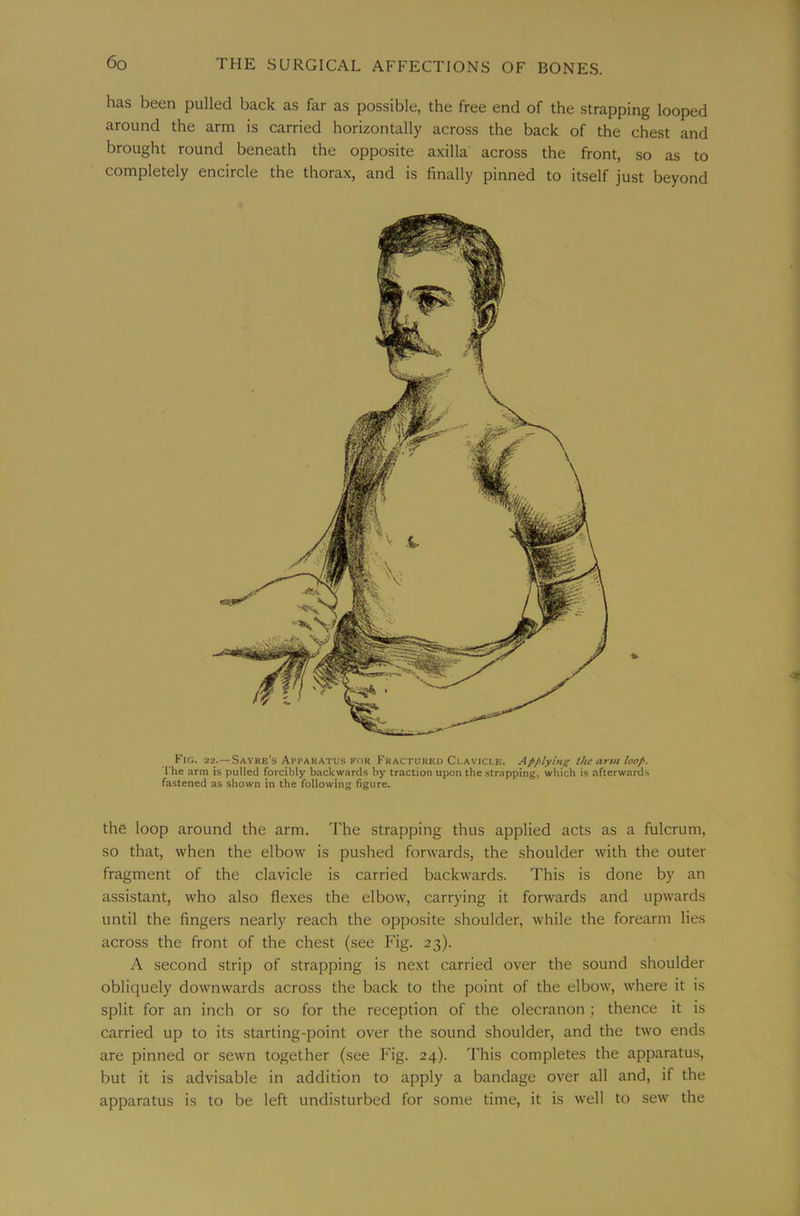 has been pulled back as far as possible, the free end of the strapping looped around the arm is carried horizontally across the back of the chest and brought round beneath the opposite axilla across the front, so as to completely encircle the thorax, and is finally pinned to itself just beyond Fig. 22.—Sayre’s Apparatus for Fractured Clavicle. Applying the arm loop. I'he arm is pulled forcibly backward.s by traction upon the strapping, which is afterwards fastened as shown in the following figure. the loop around the arm. The strapping thus applied acts as a fulcrum, so that, when the elbow is pushed forwards, the shoulder with the outer fragment of the clavicle is carried backwards. This is done by an assistant, who also flexes the elbow, carrying it forwards and upwards until the fingers nearly reach the opposite shoulder, while the forearm lies across the front of the chest (see Fig. 23). A second strip of strapping is next carried over the sound shoulder obliquely downwards across the back to the point of the elbow, where it is split for an inch or so for the reception of the olecranon ; thence it is carried up to its starting-point over the sound shoulder, and the two ends are pinned or sewn together (see Fig. 24). This completes the apparatus, but it is advisable in addition to apply a bandage over all and, if the apparatus is to be left undisturbed for some time, it is well to sew the