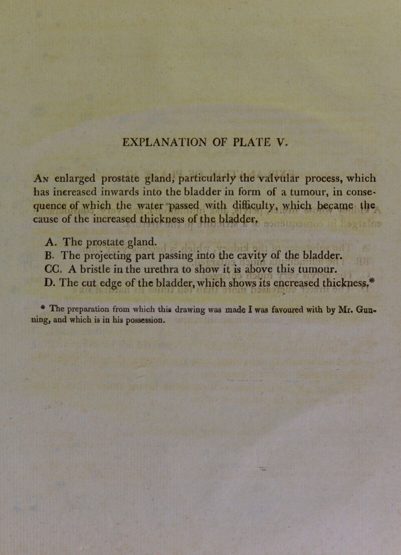 An enlarged prostate gland; particularly the valvular process, which has increased inwards into the bladder in form of a tumour, in conse- quence of which the water passed, with difhcvilty, which became the cause of the increased thickness of the blad4e**f A. The prostate gland. . . . , . . ^ B. The projecting part passing into the cavity of the bladder. CC. A bristle in the urethra to’show it is above this tumour. D. The cut edge of the bladder, which showa its encreased thickness,* The preparation from which this drawing was made I was favoured with by Mr. Gun* ning, and which is in his possession.